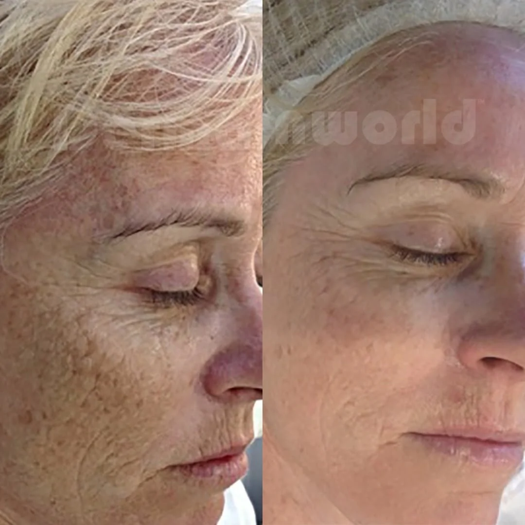 Click Above for More DP4 Microneedling Results