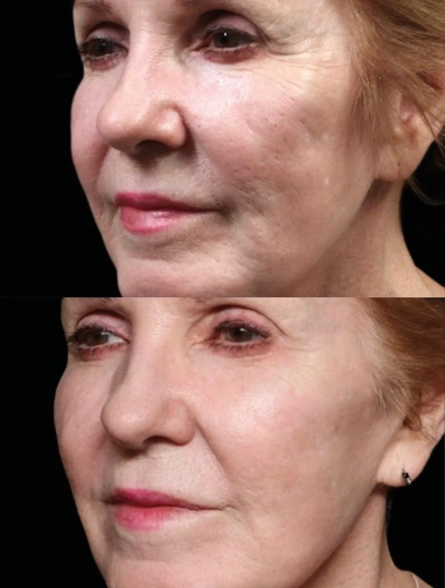 Exion Fractional RF Microneedling