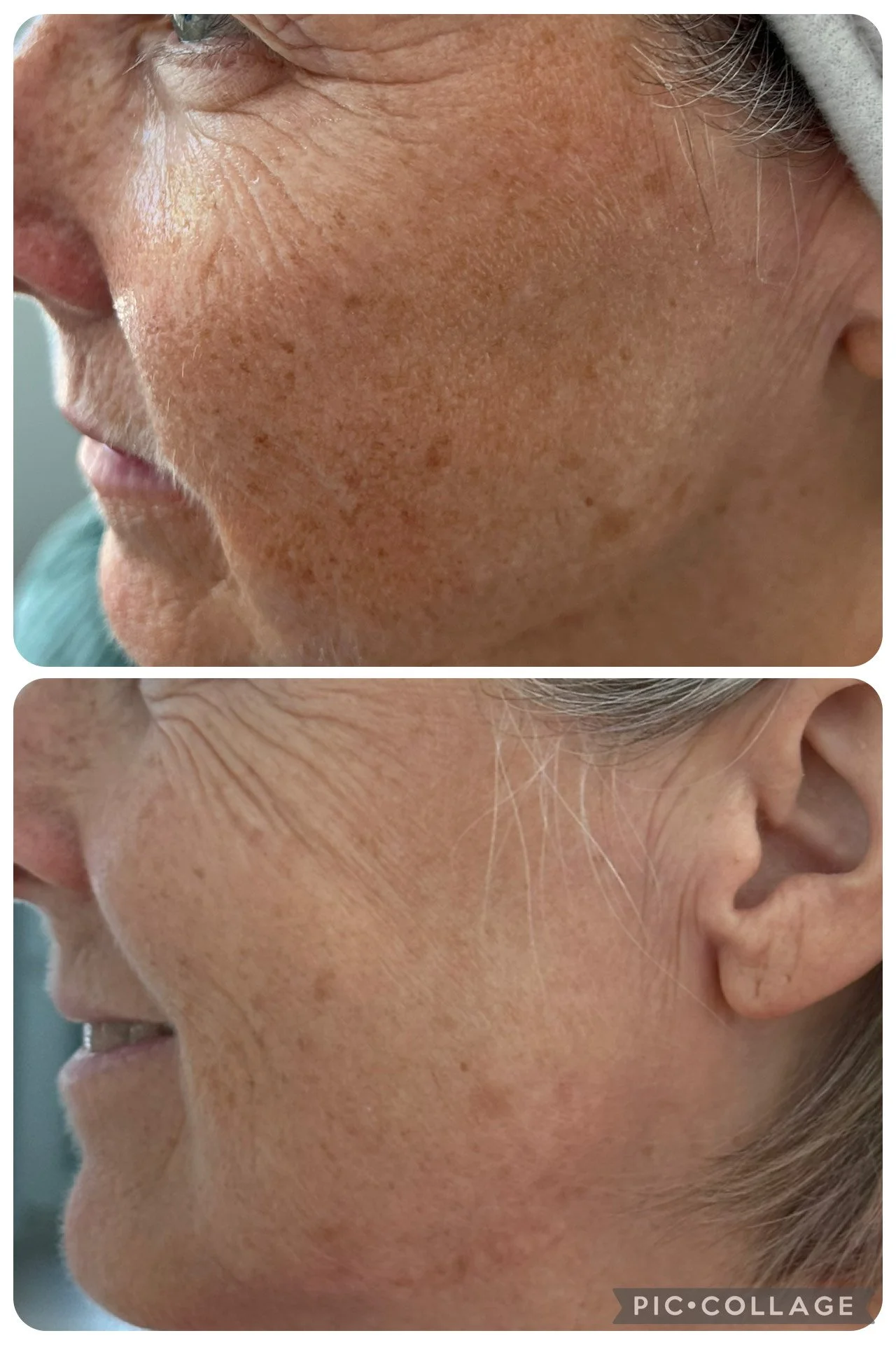 Before and after images of a person's cheek showing reduction in dark spots and skin improvement.