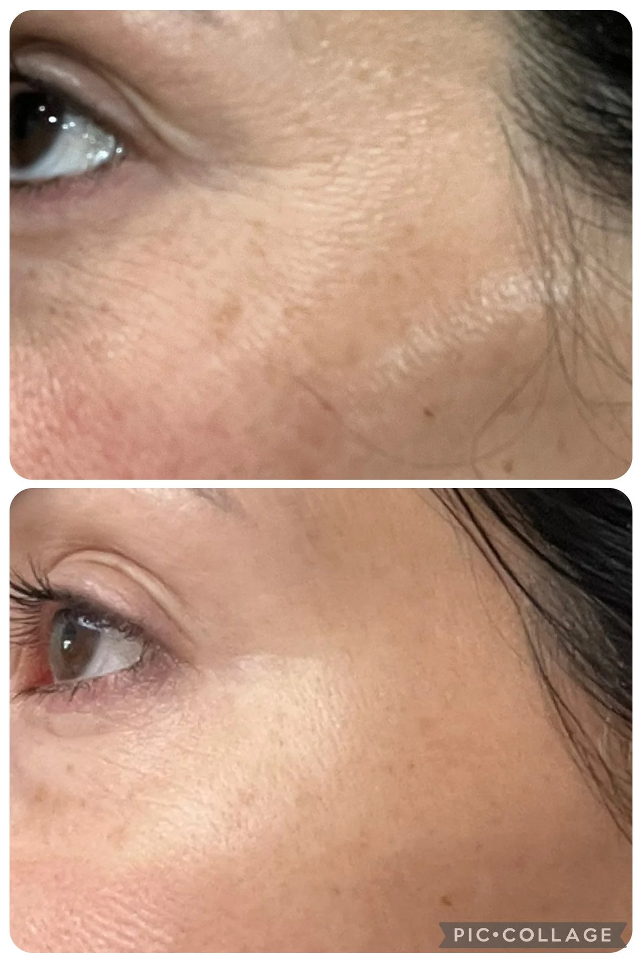 Close-up of a woman's face showing a before-and-after comparison of skin appearance, with clearer skin in the after photo.