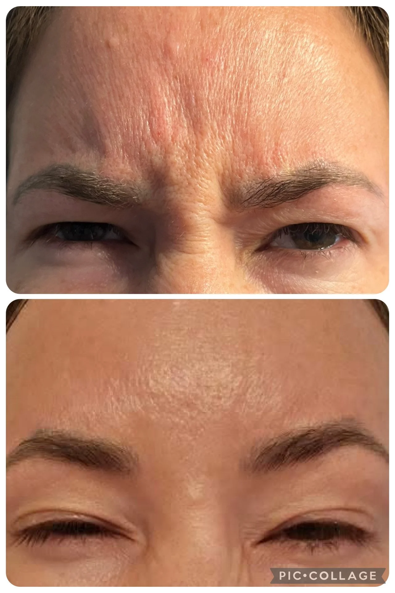 Comparison of a person's forehead and eyes before and after skincare, showing reduced wrinkles and smoother skin in the after photo.