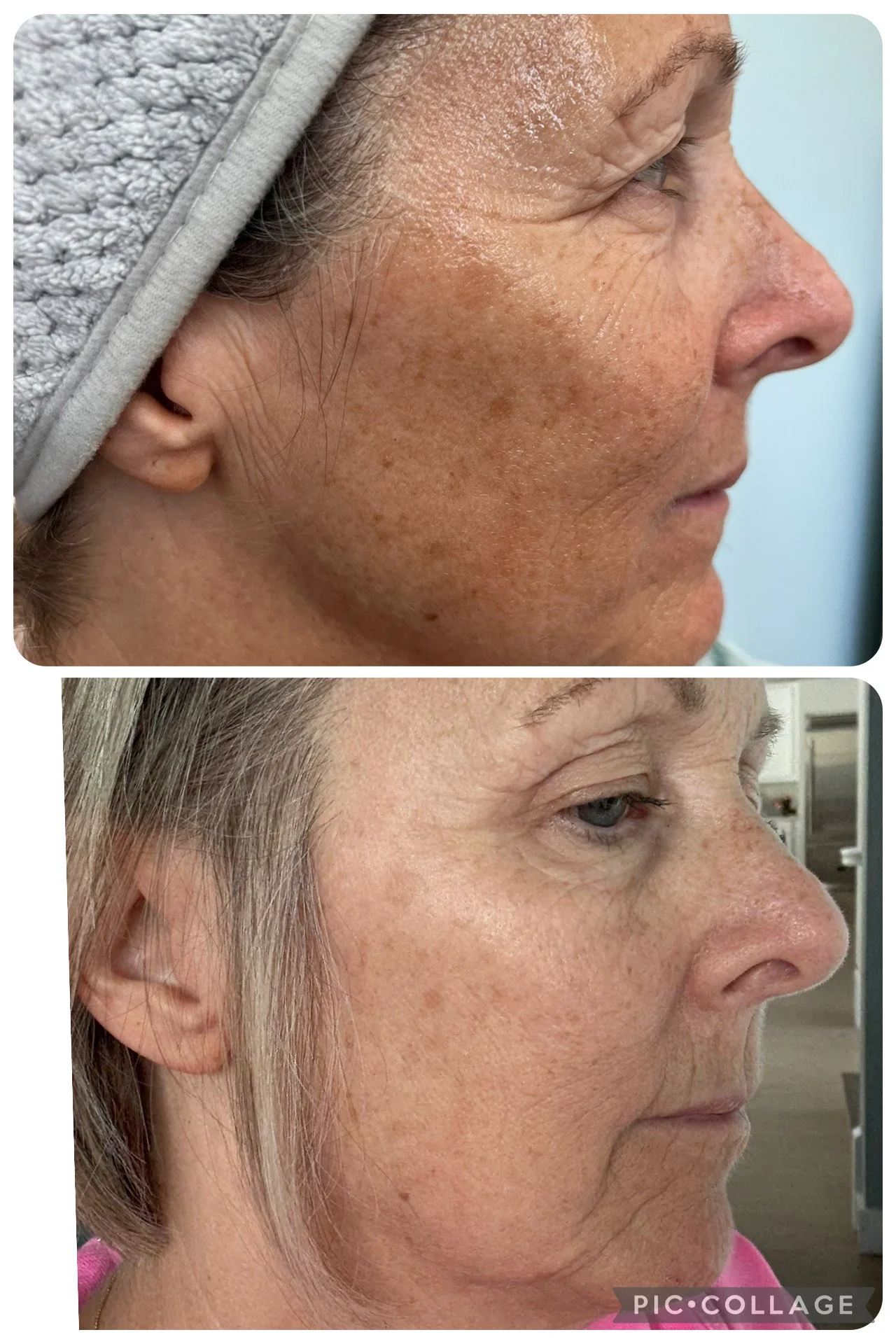 Side-by-side comparison of a woman’s facial skin before and after skincare treatment, showing reduced pigmentation and smoother skin.