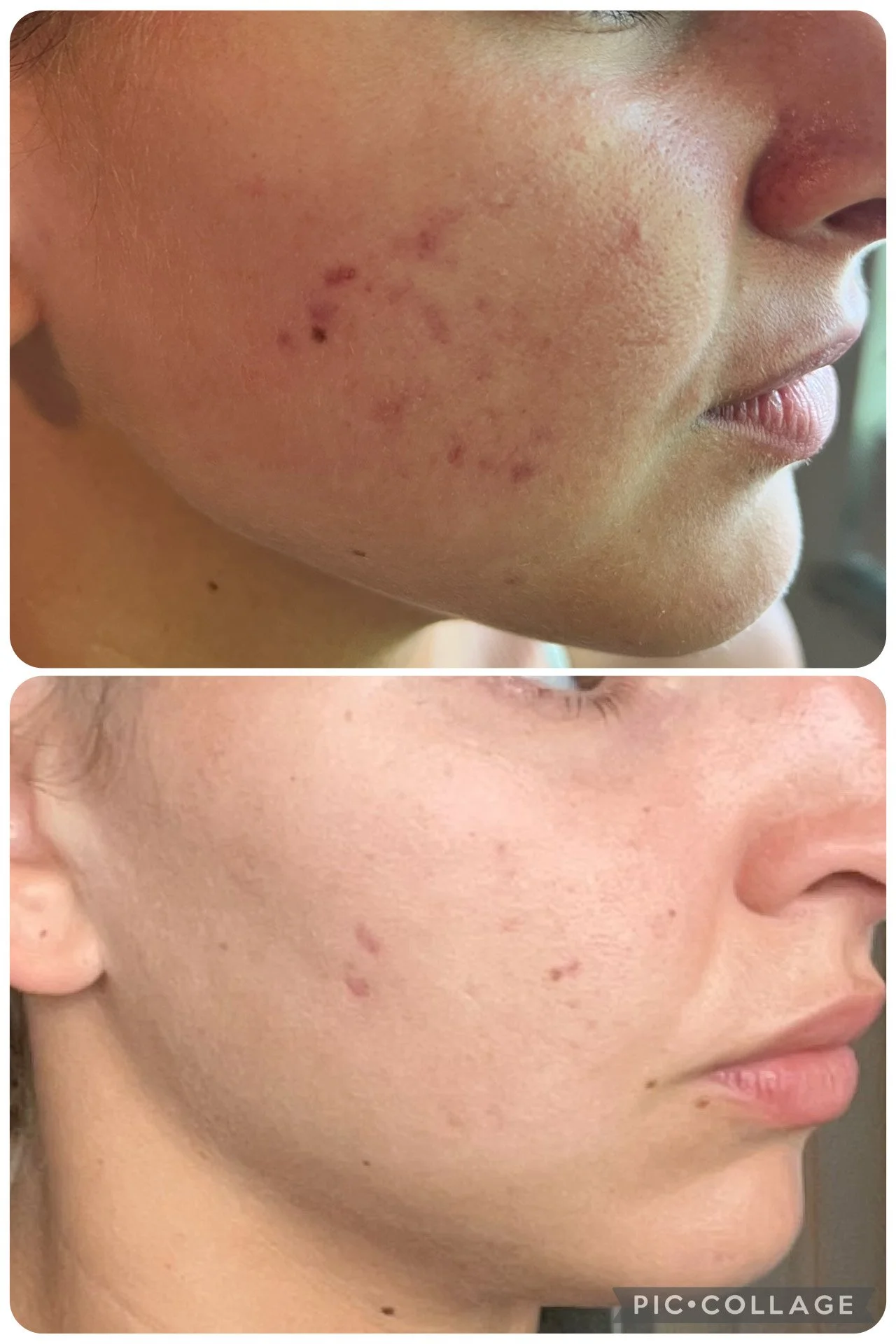 Comparison of a person's cheek before and after treatment showing improvement in acne scars and skin texture.
