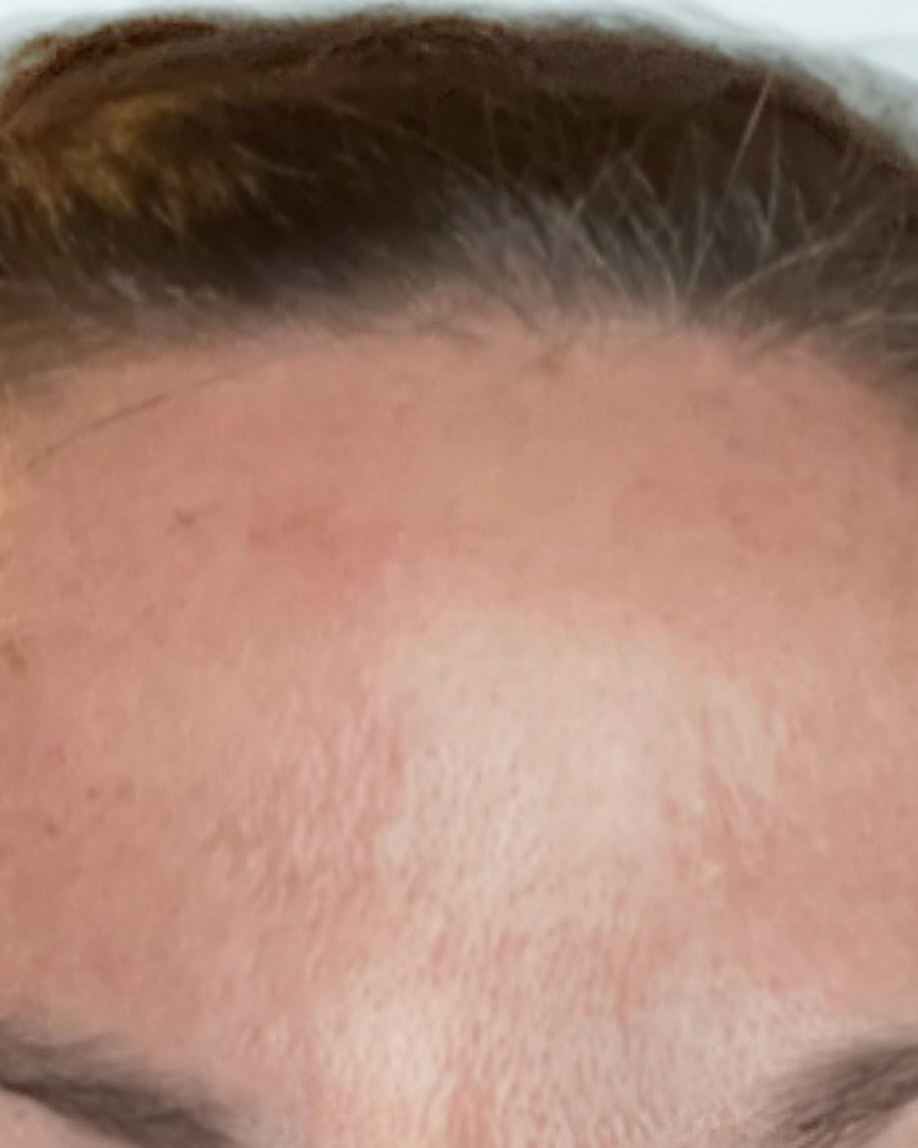Client after Xeomin treatment, with smoother skin, softened facial lines, and reduced redness.