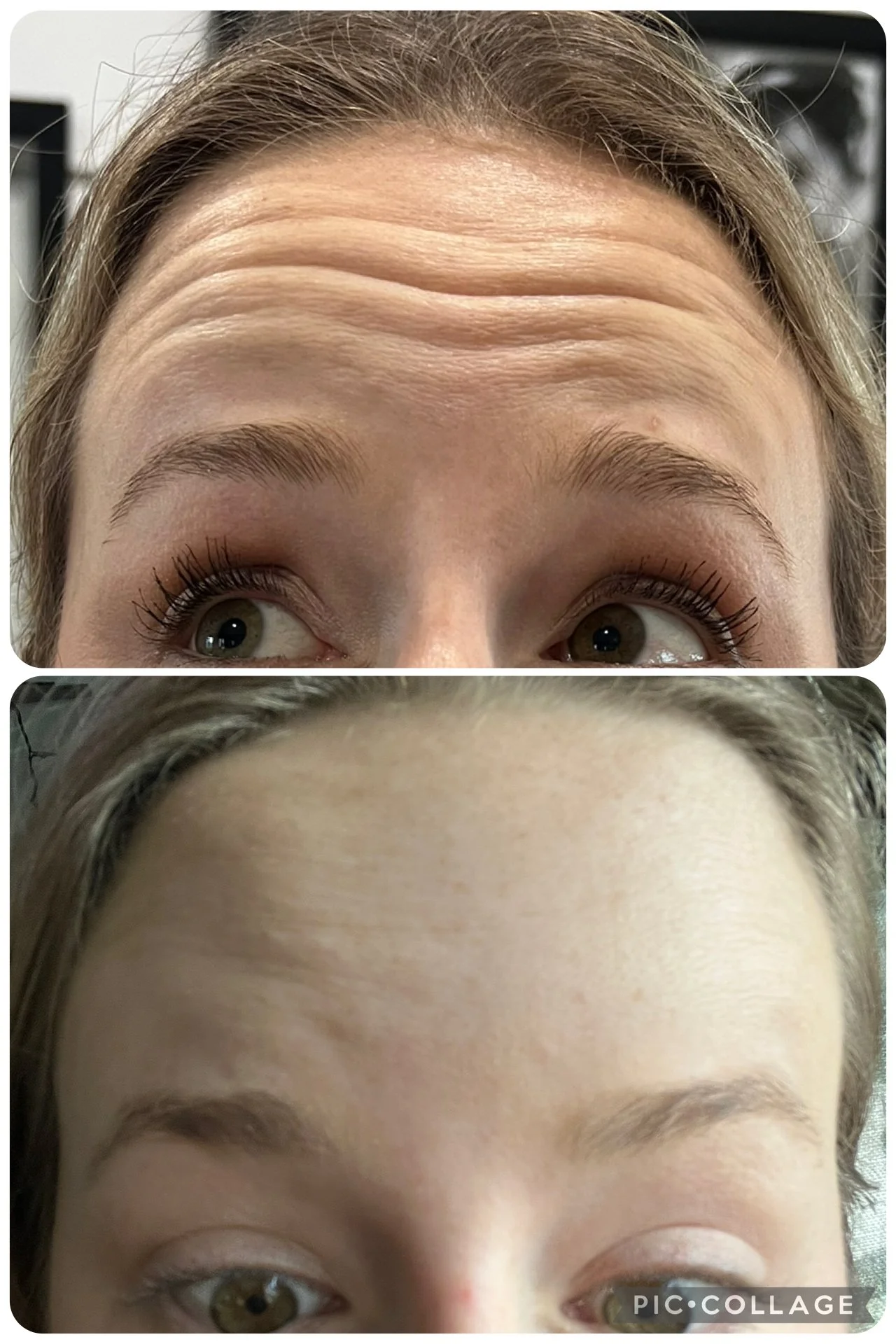 Comparison photo showing a person's forehead before and after Botox treatment, with the top image showing forehead wrinkles and the bottom image showing a smooth forehead.