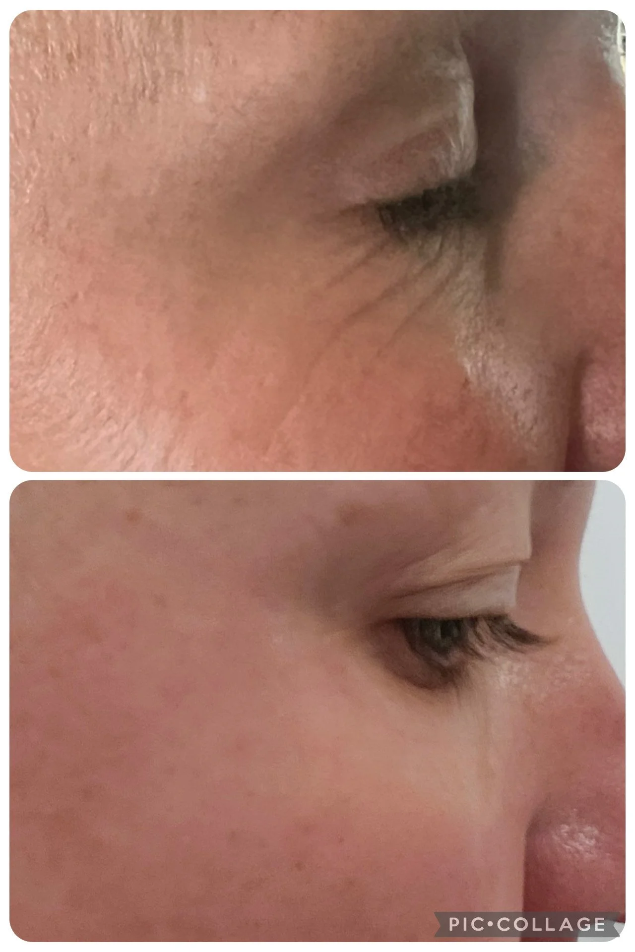 Close-up comparison of a person's face, showing the area around the eye before and after treatment or skincare, highlighting improved skin texture and reduced wrinkles.