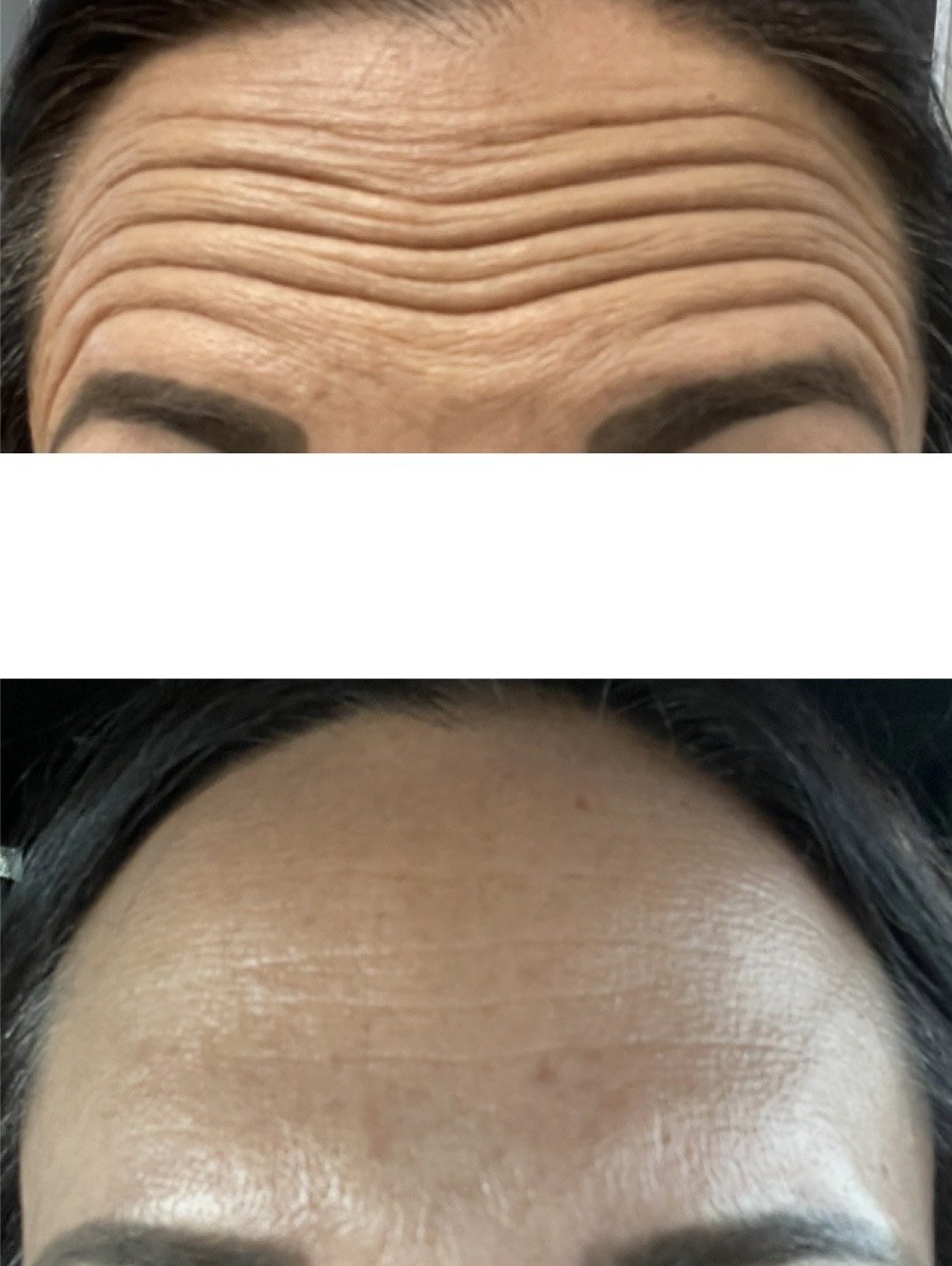 Close-up of a woman’s forehead showing deep wrinkles in the top image and smooth skin in the bottom image.