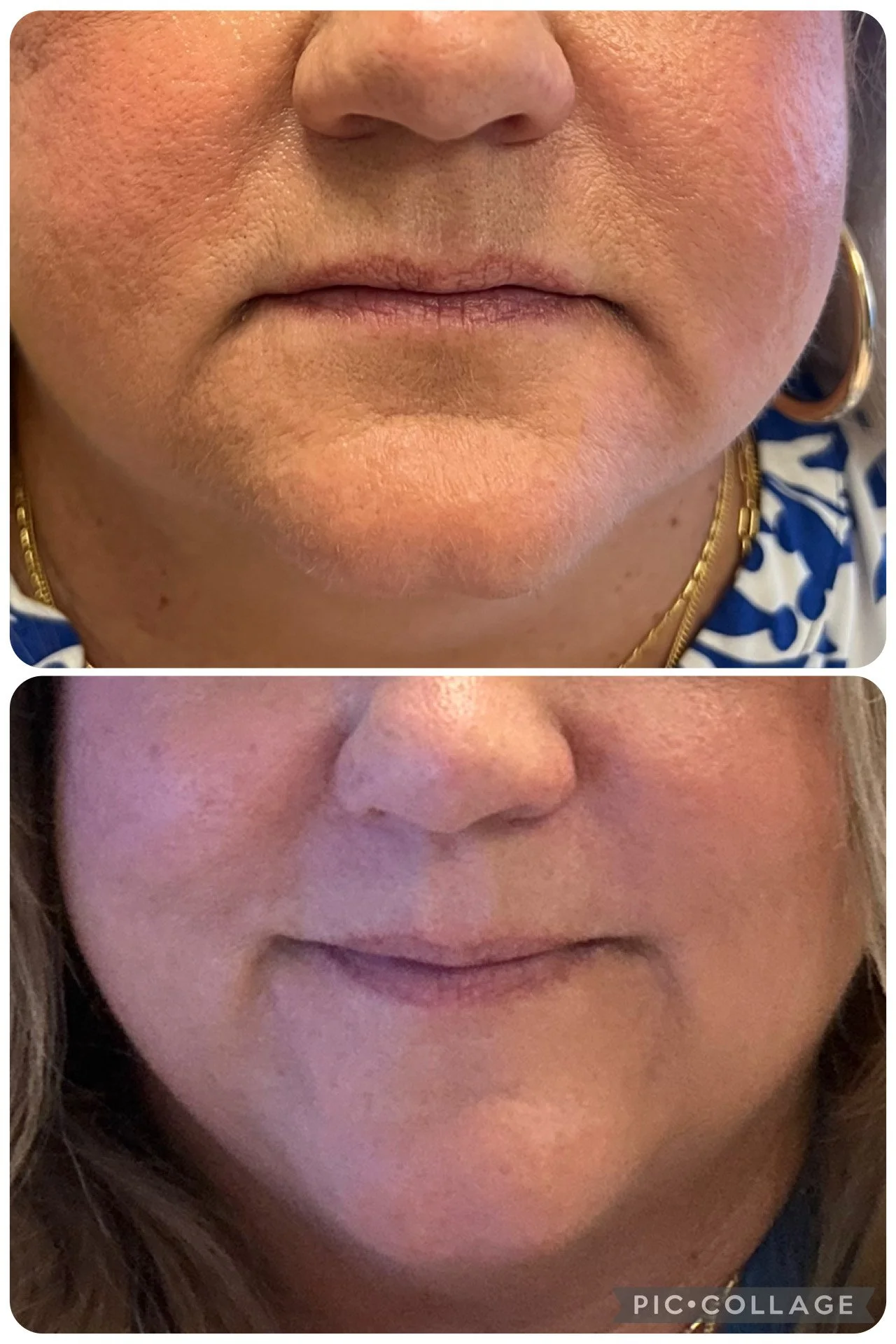 Close-up of two women's lower faces before and after skincare treatment, showing improved skin texture and appearance