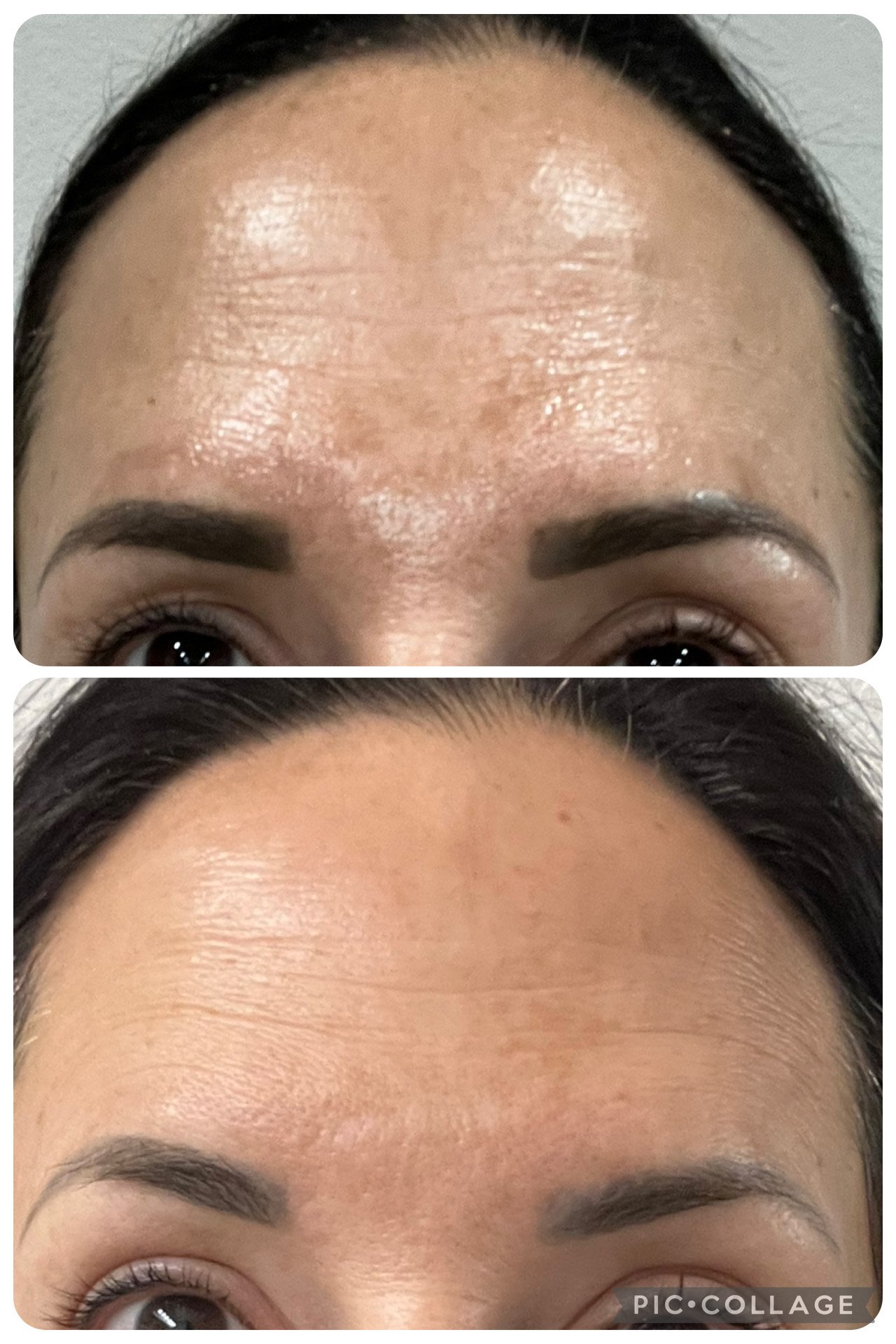 Close-up of a woman's forehead showing significant skin clearance and reduction in wrinkles after skincare treatment.