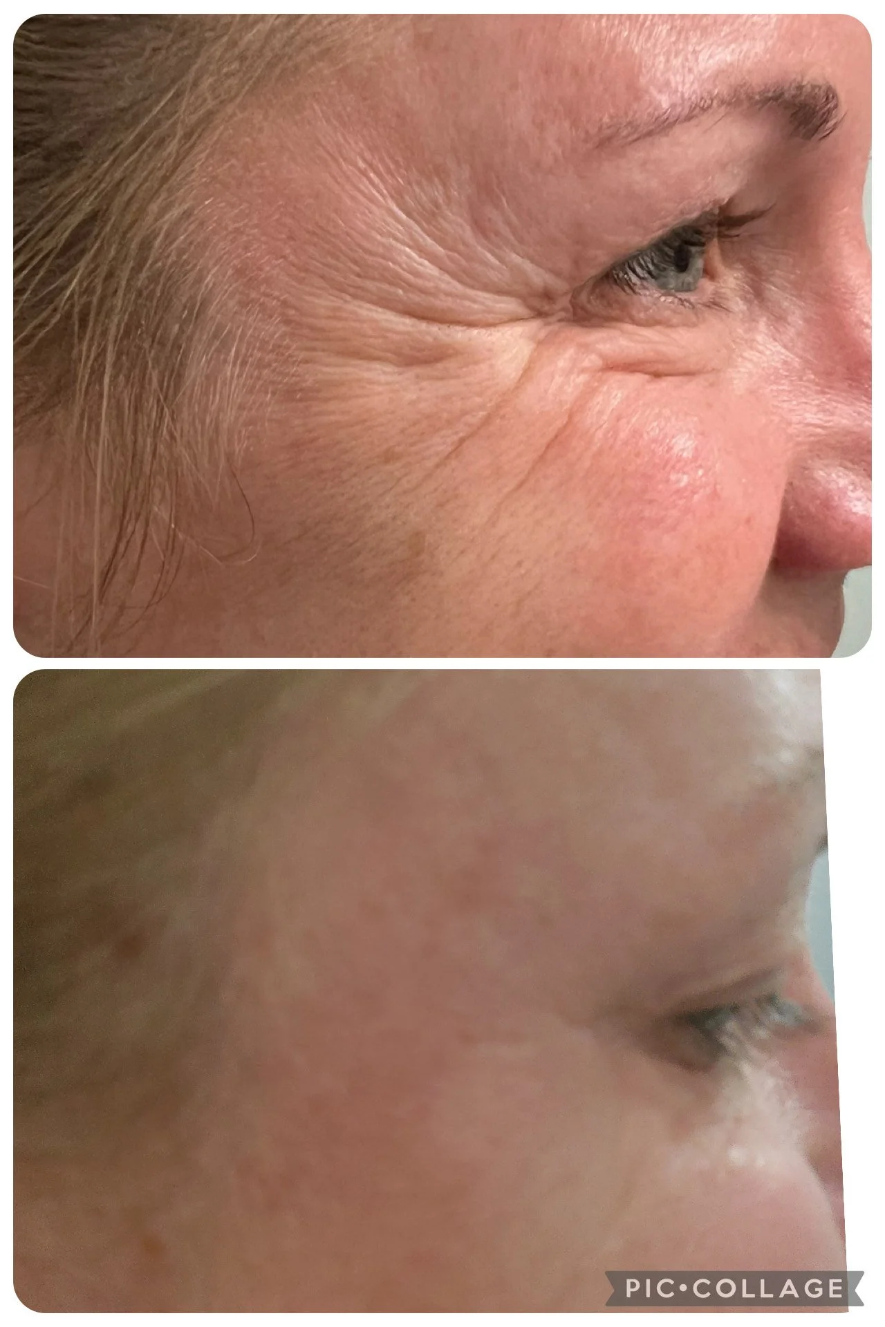 Close-up of the side of a woman's face showing wrinkles around the eye and forehead, with a smooth and youthful complexion in the lower part of the image.