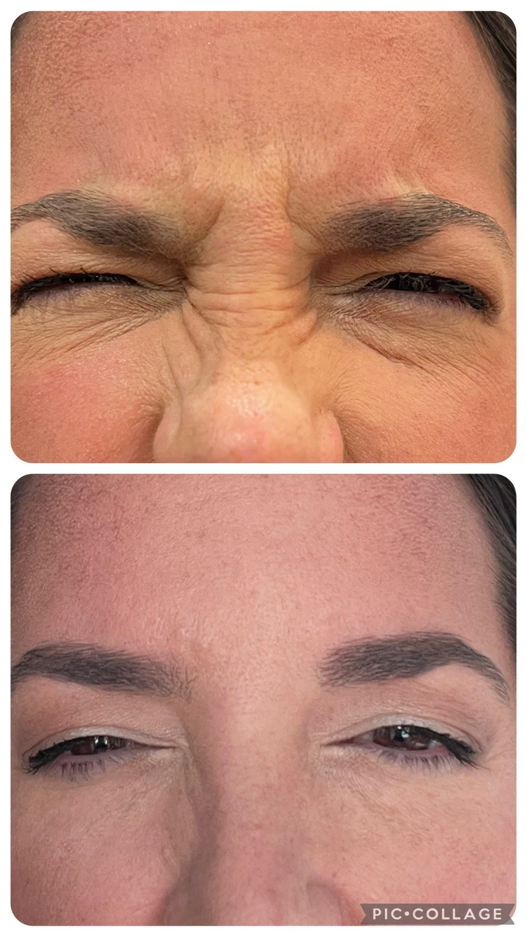 Close-up comparison of a woman's face showing a dramatic reduction in wrinkles around the eyes after treatment, with visible improvements in skin smoothness and appearance.