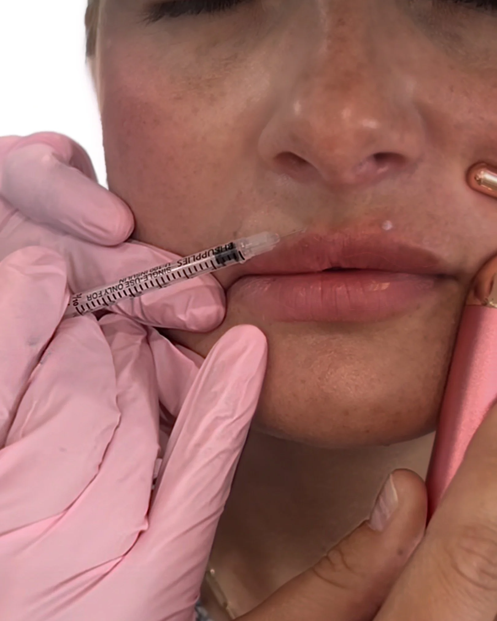 Xeomin lip flip procedure with syringe being injected into client’s lip.