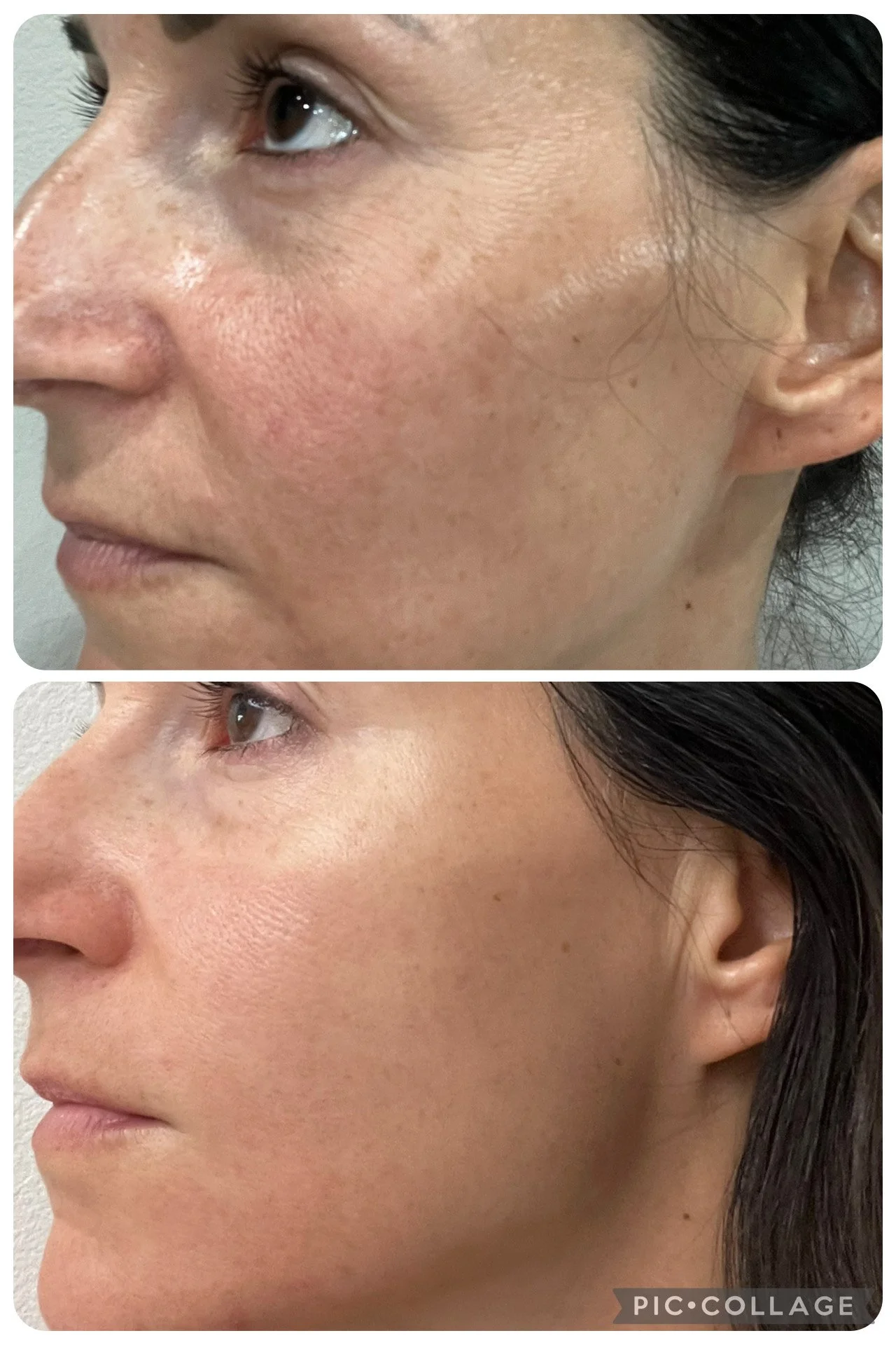 Side-by-side comparison of a woman's face before and after skincare treatment, showing reduced redness, smaller pores, and smoother skin in the after photo.