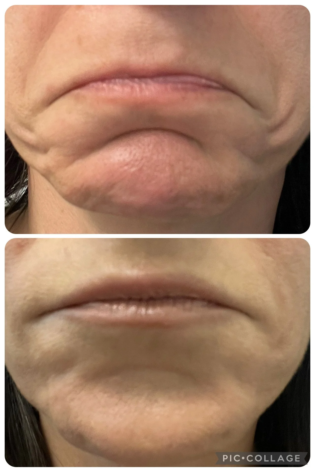 Comparison of lips before and after treatment, showing reduced wrinkles and smoother skin around the mouth.
