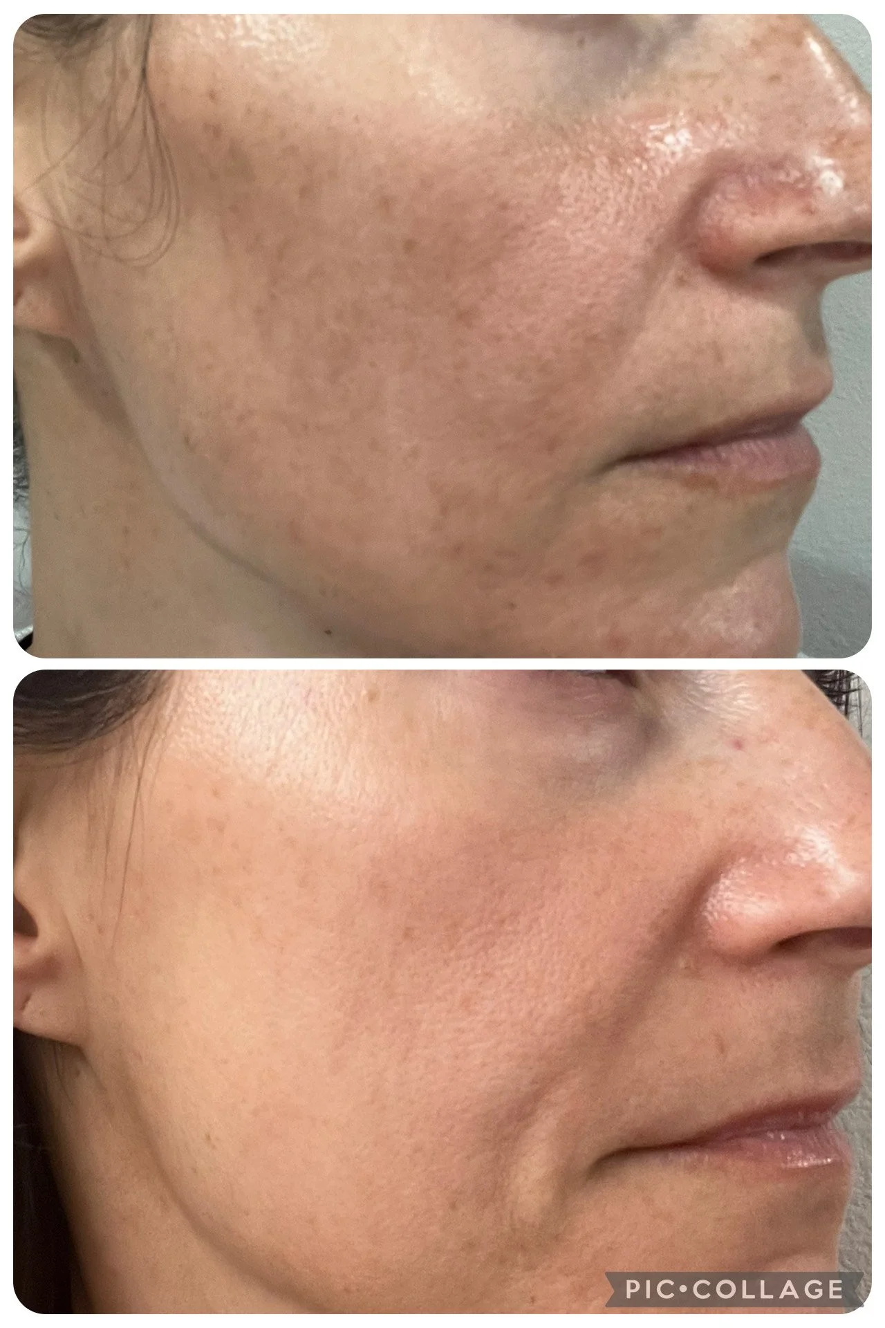 Close-up side-by-side images of a person's cheek, showing improvement in skin texture and reduction of dark spots and pigmentation in the second image compared to the first.