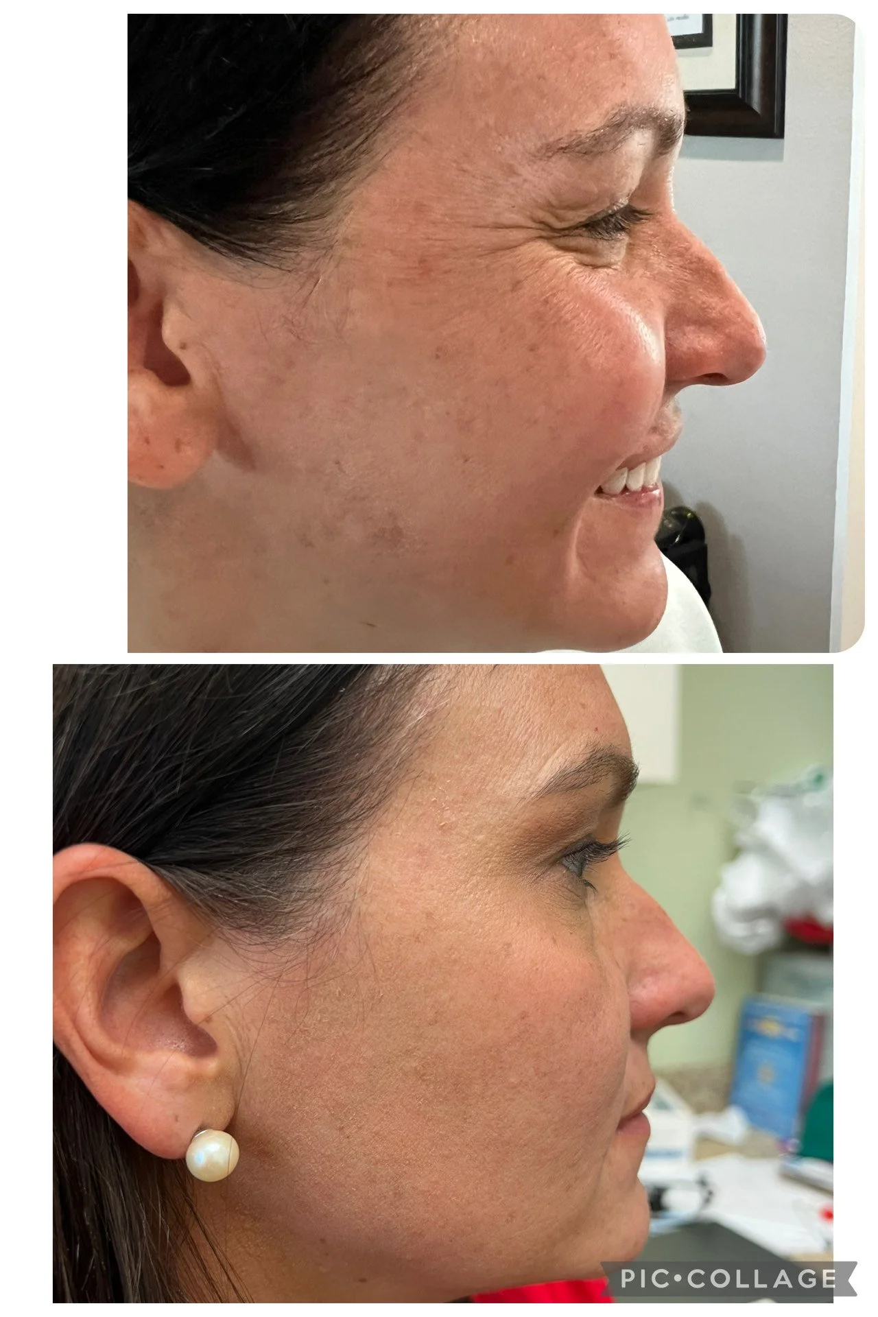 Side-by-side comparison of a woman's face before and after skincare or cosmetic treatment. The top image shows her with red, uneven skin, and the bottom image shows smoother, clearer skin with a pearl earring.