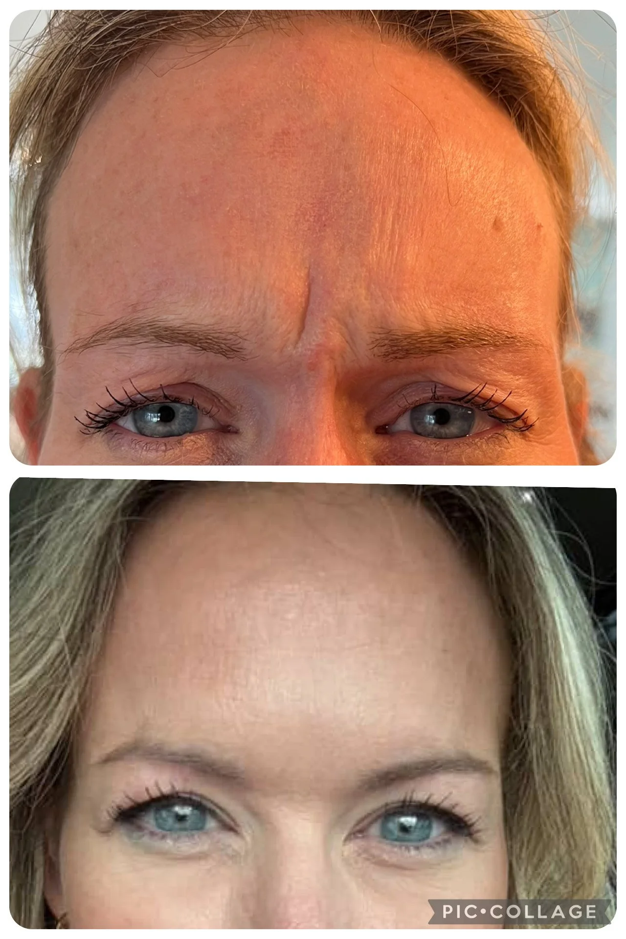 Before and after photos showing a person's forehead and eyes, with smooth skin and no wrinkles in the after image.