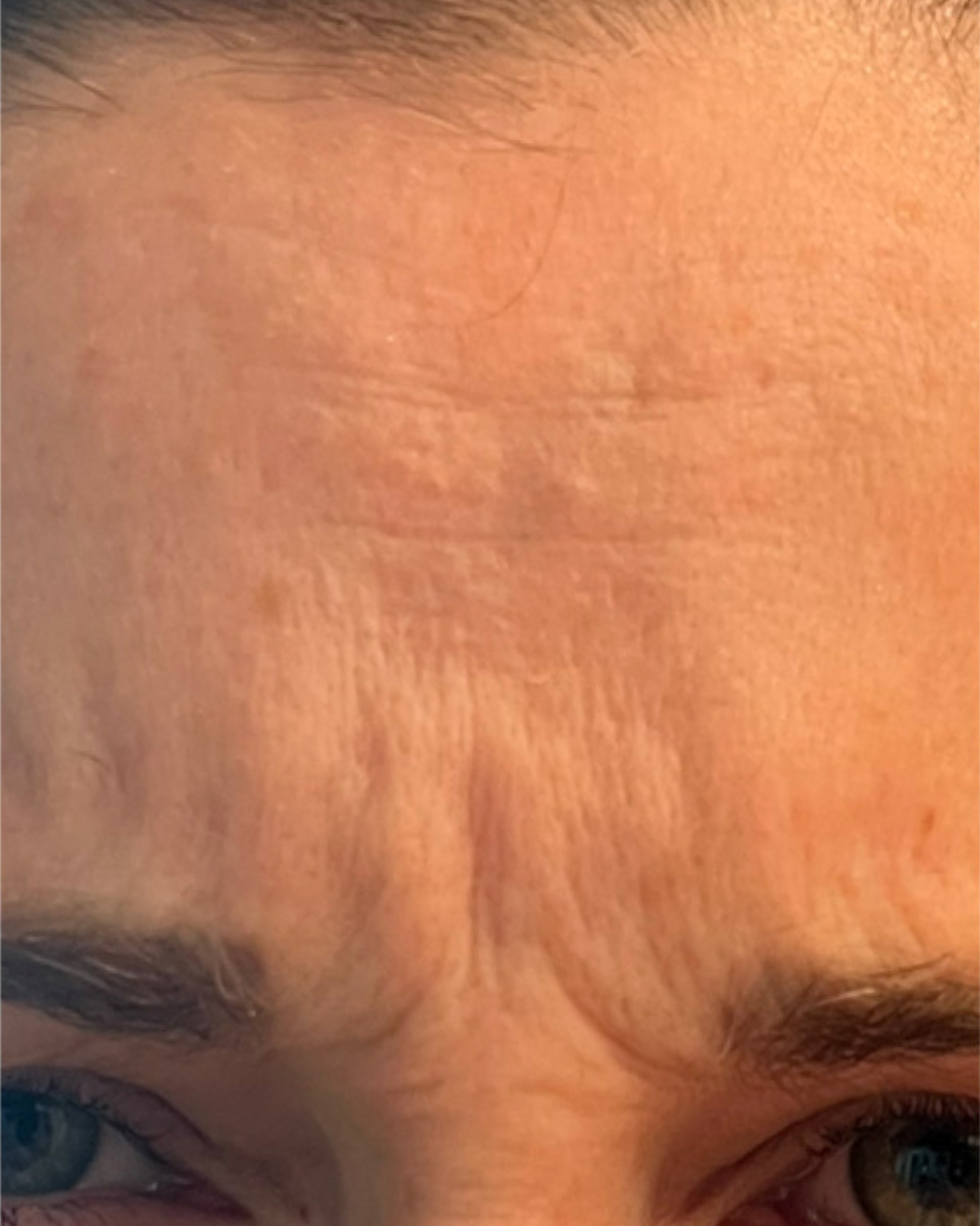 Client after Xeomin treatment with smoother skin and softened facial lines.