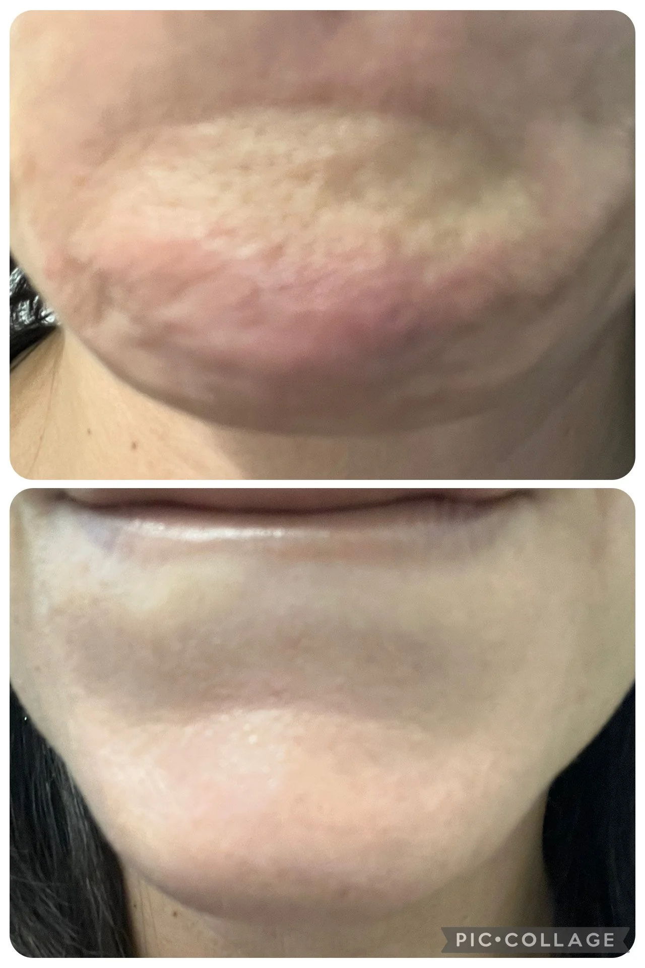 Comparison of lips before and after treatment, showing improved skin texture and appearance.