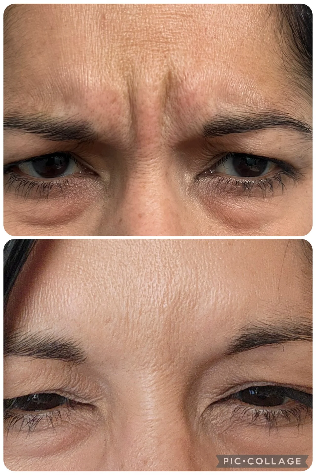 Close-up of a person's forehead, showing significant reduction in wrinkles and skin texture improvement in the second image compared to the first.