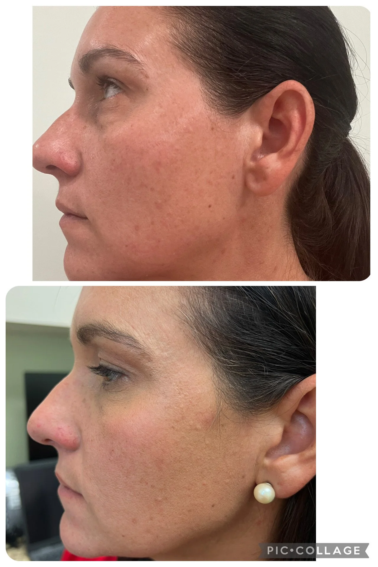 Comparison of a woman's face before and after skincare treatment, showing improved skin texture, reduced redness, and clearer complexion.