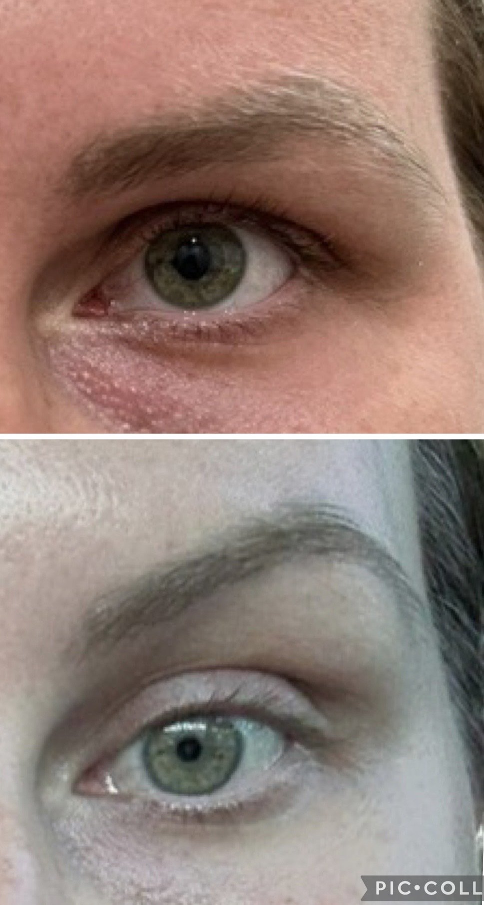 Comparison of close-up images of a person's eye, with the top image in color showing natural skin tone and the bottom image in black and white.