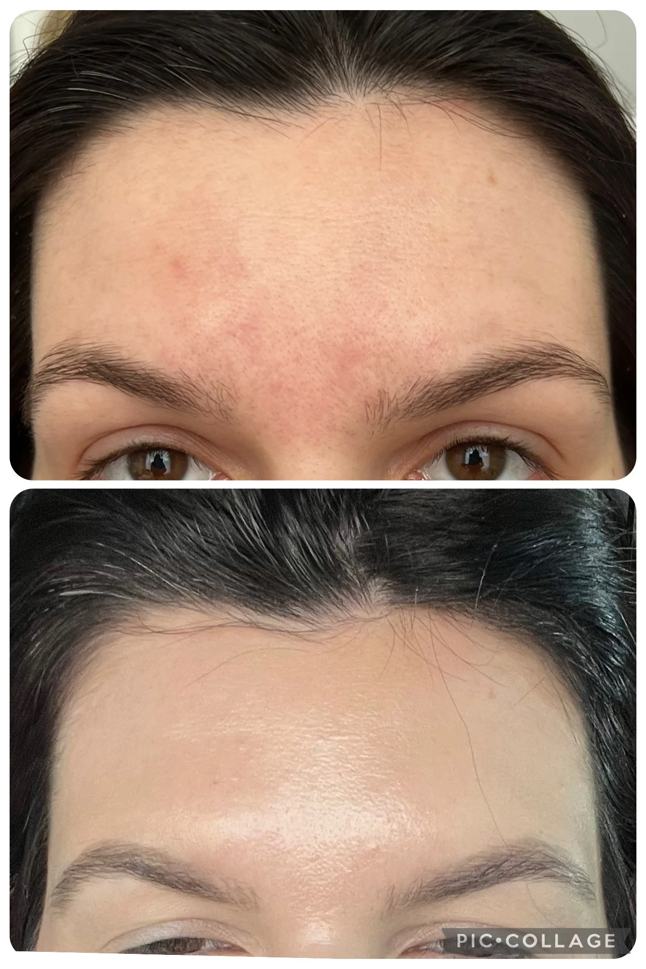 Before and after images showing a person's forehead, with the top image depicting redness and skin irritation, and the bottom image showing clear, smooth skin after treatment.