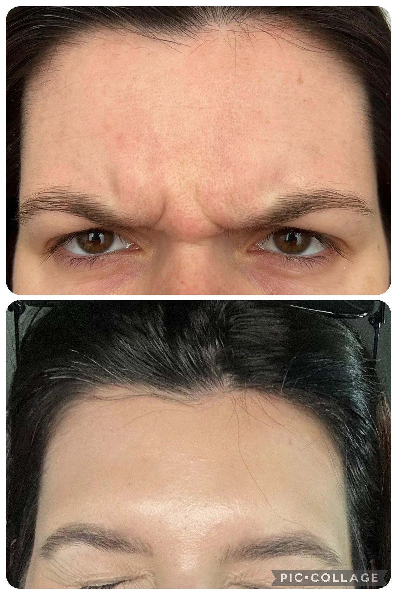 Comparison of a person's forehead and eyebrows before and after hair removal; the top image shows furrowed brows and a bumpy forehead, while the bottom image shows smooth skin and groomed eyebrows.