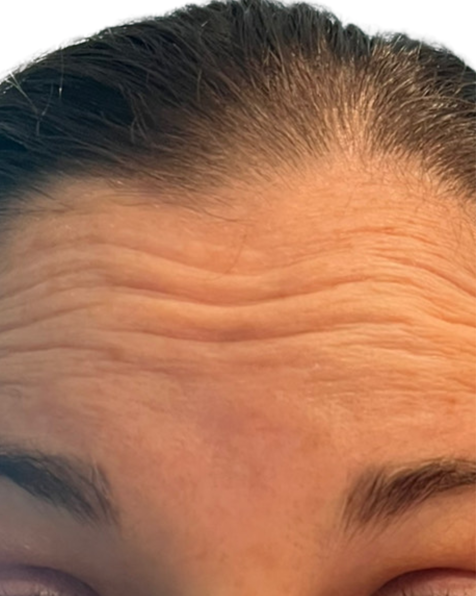 Client before Xeomin treatment, showing natural facial lines and expressions.