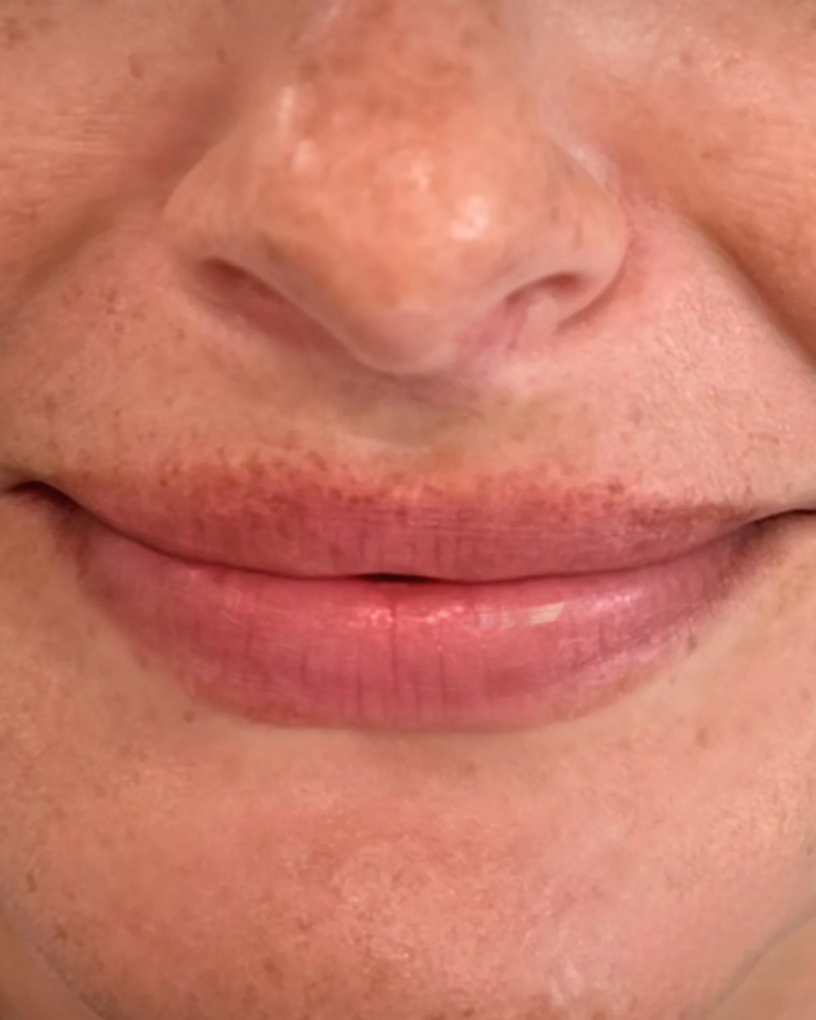 Client immediately after Xeomin lip flip, showing subtle enhancement.