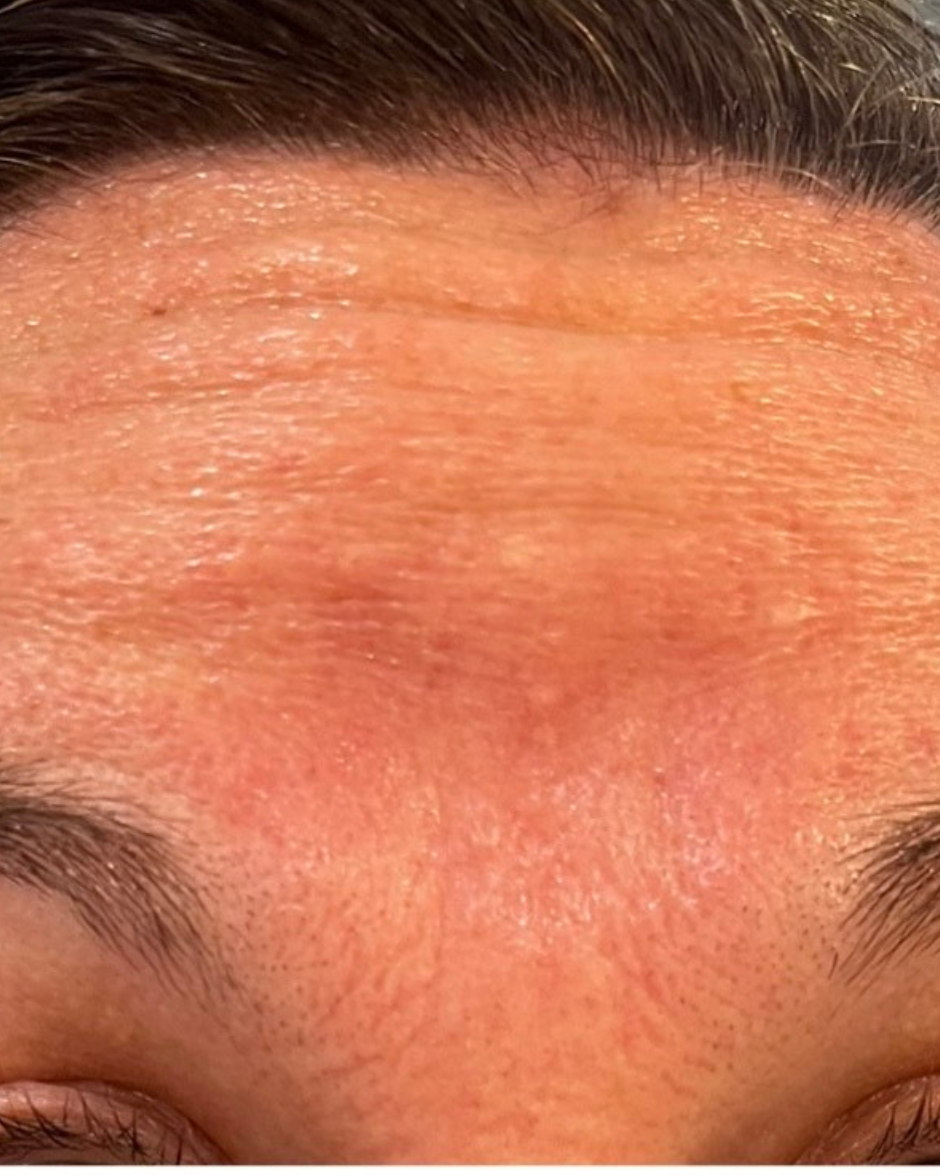 Client before Xeomin treatment, showing natural facial lines, expressions, and some redness in the skin.