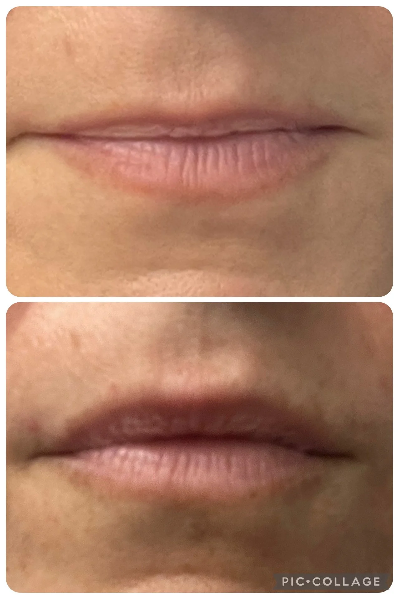 Comparison of lips, top photo shows dry lips, bottom photo shows moisturized lips.