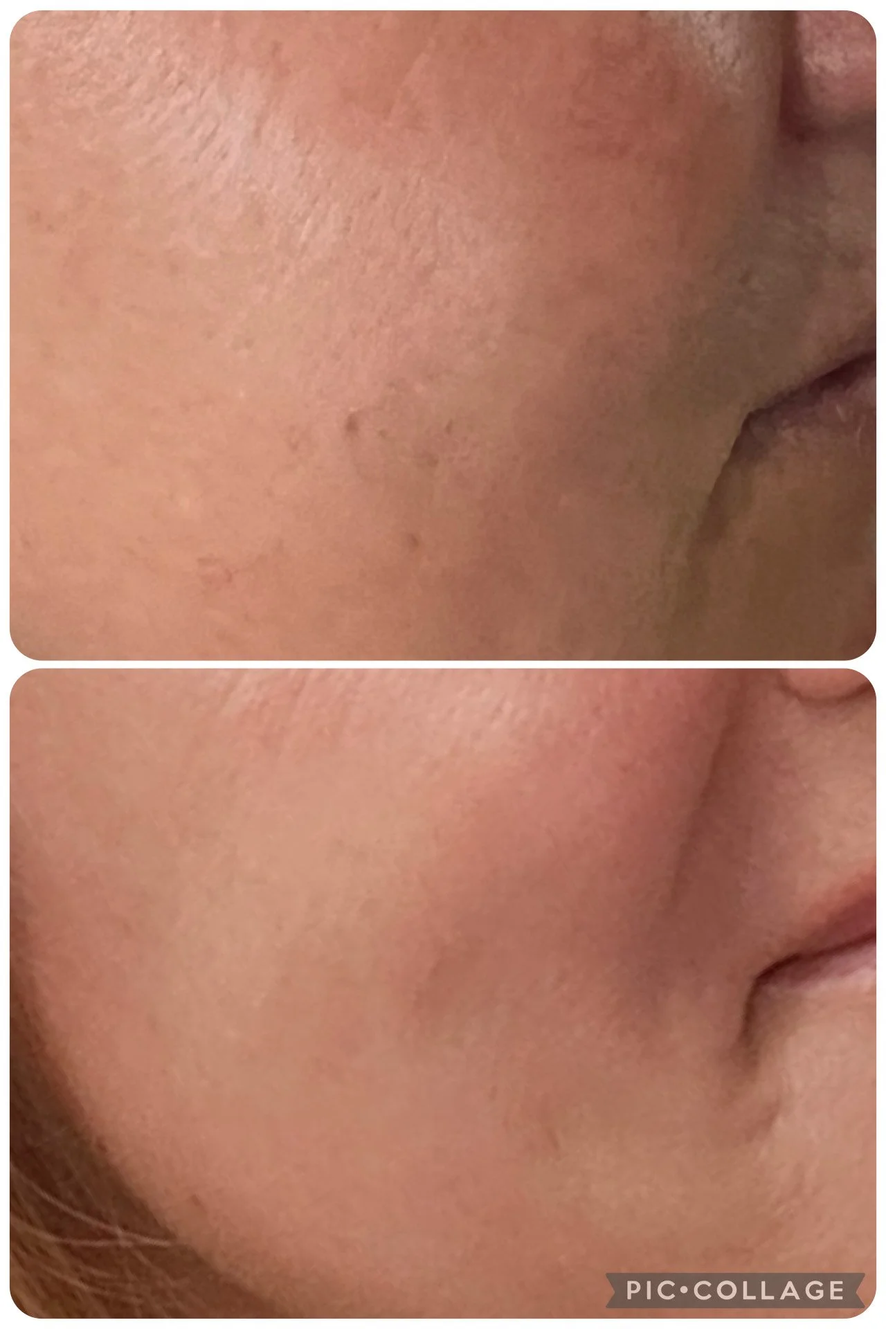 Close-up comparison of facial skin before and after skincare treatment, showing reduced pores and smoother texture.