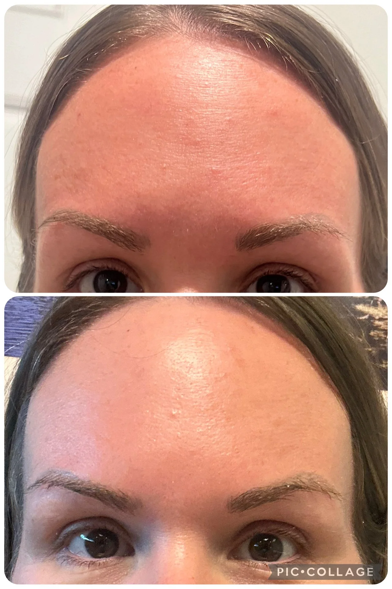 Before and after close-up photos of a woman's forehead, showing improved skin texture and reduced redness after skincare or treatment.