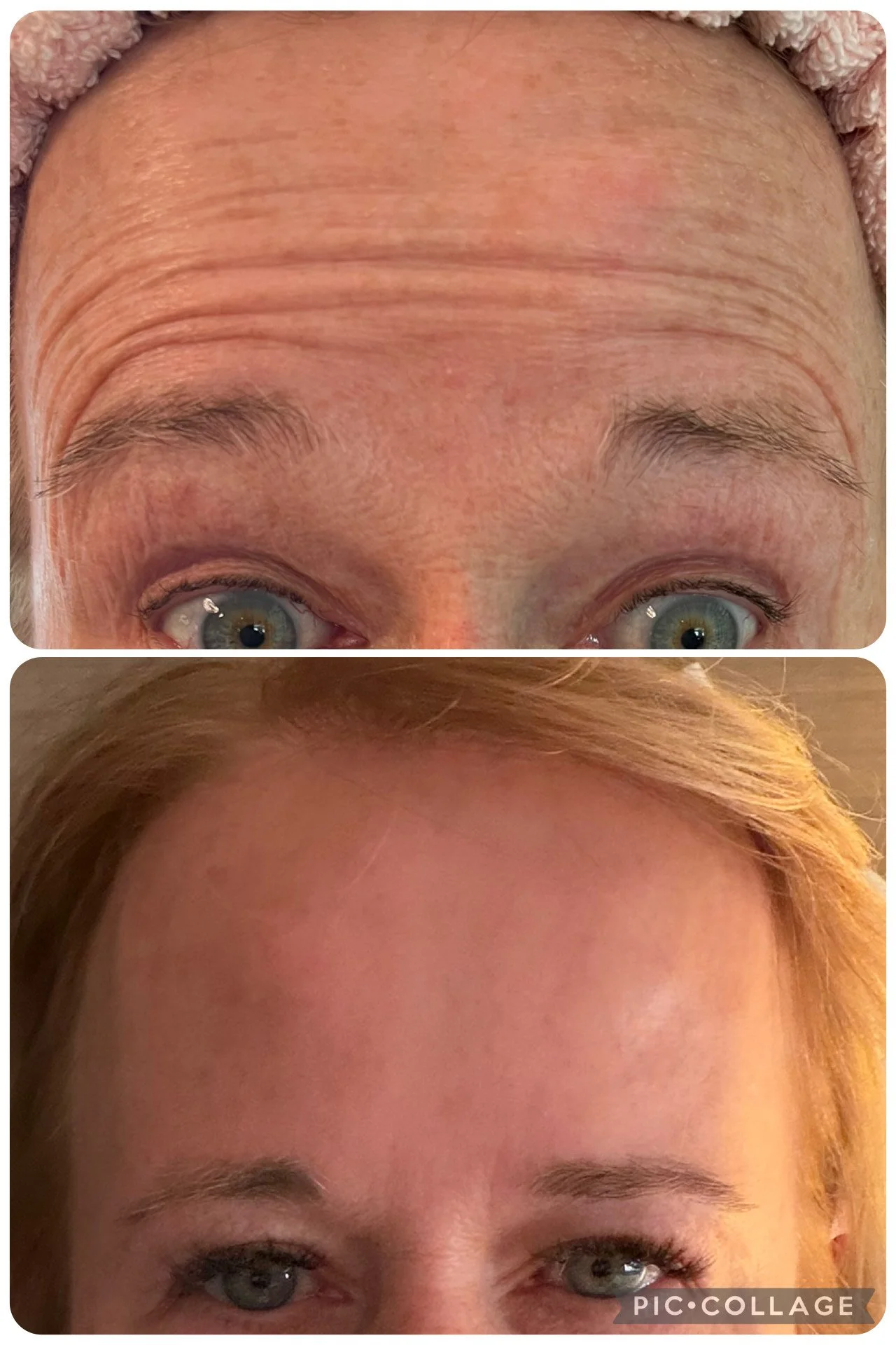 Comparison of a woman's forehead with wrinkles in the top image and smooth skin in the bottom image.