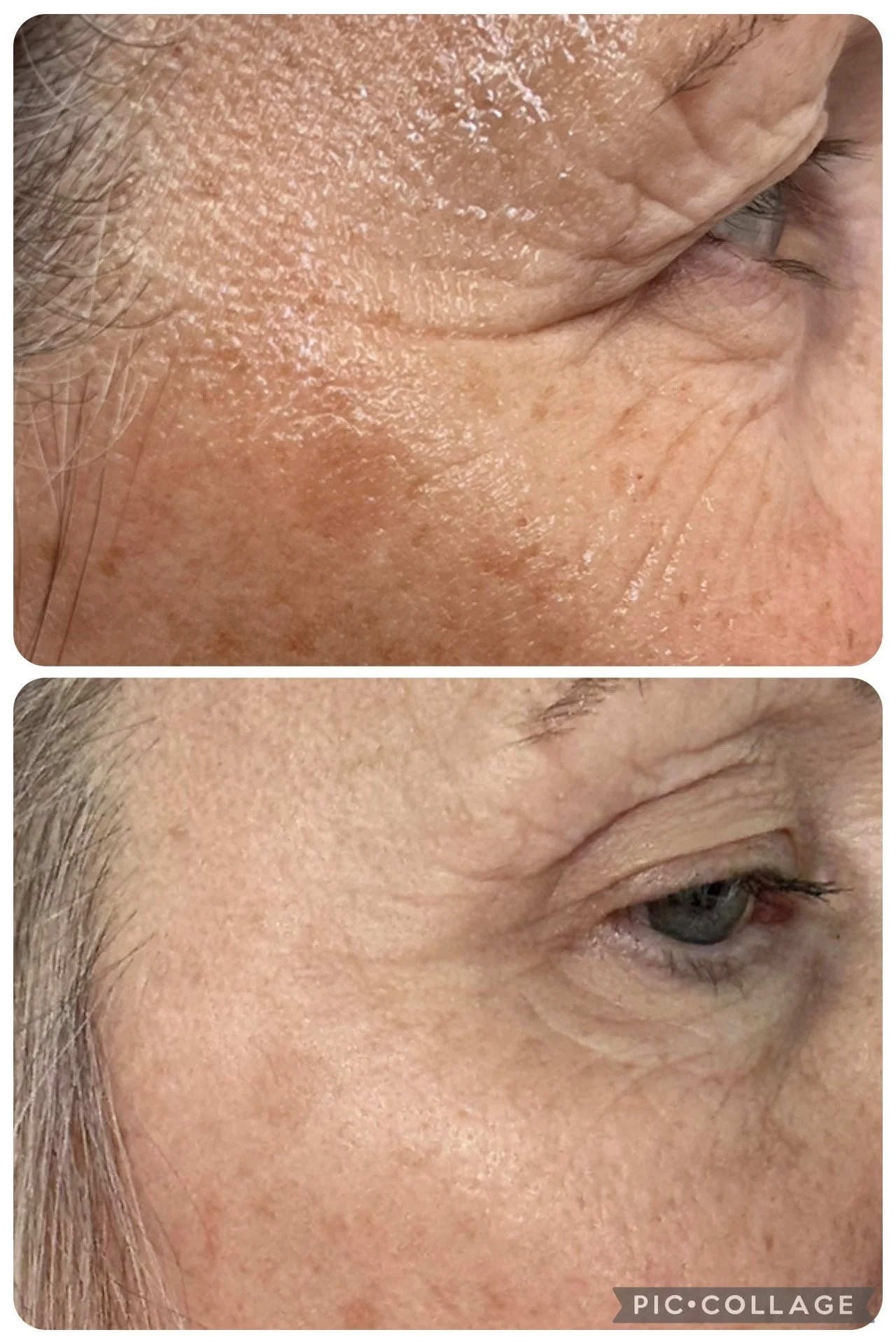 Side-by-side close-up images of a person's face, showing skin improvement. The top image shows rough, oily, and wrinkled skin with visible pores, while the bottom image shows smoother, clearer skin with fewer wrinkles and enlarged pores.