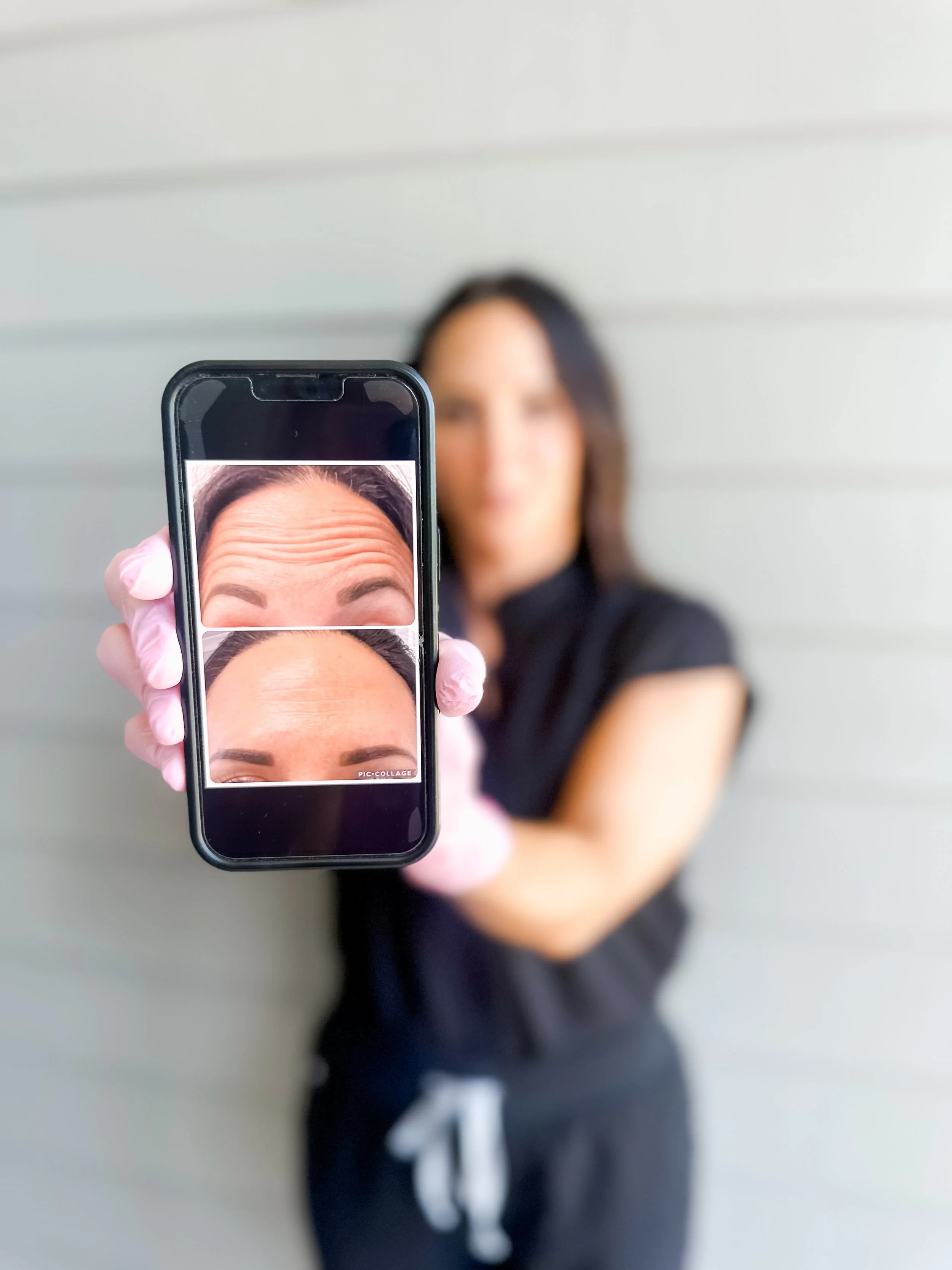 APRN showing before-and-after results of Xeomin® Injections for facial wrinkle reduction and skin rejuvenation.