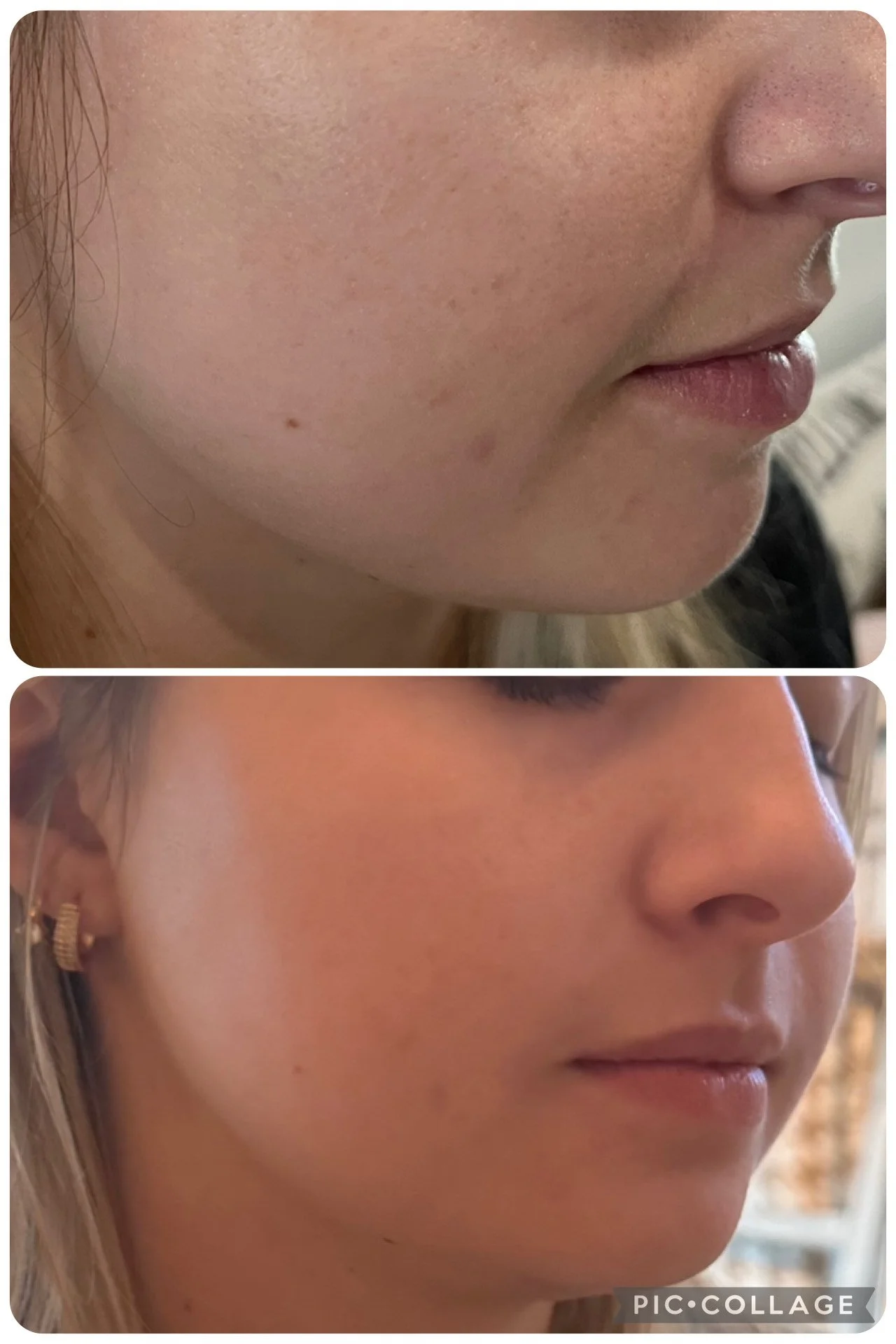 Comparison of a woman's face before and after skincare; the top shows skin with blemishes, the bottom shows clearer, smoother skin.