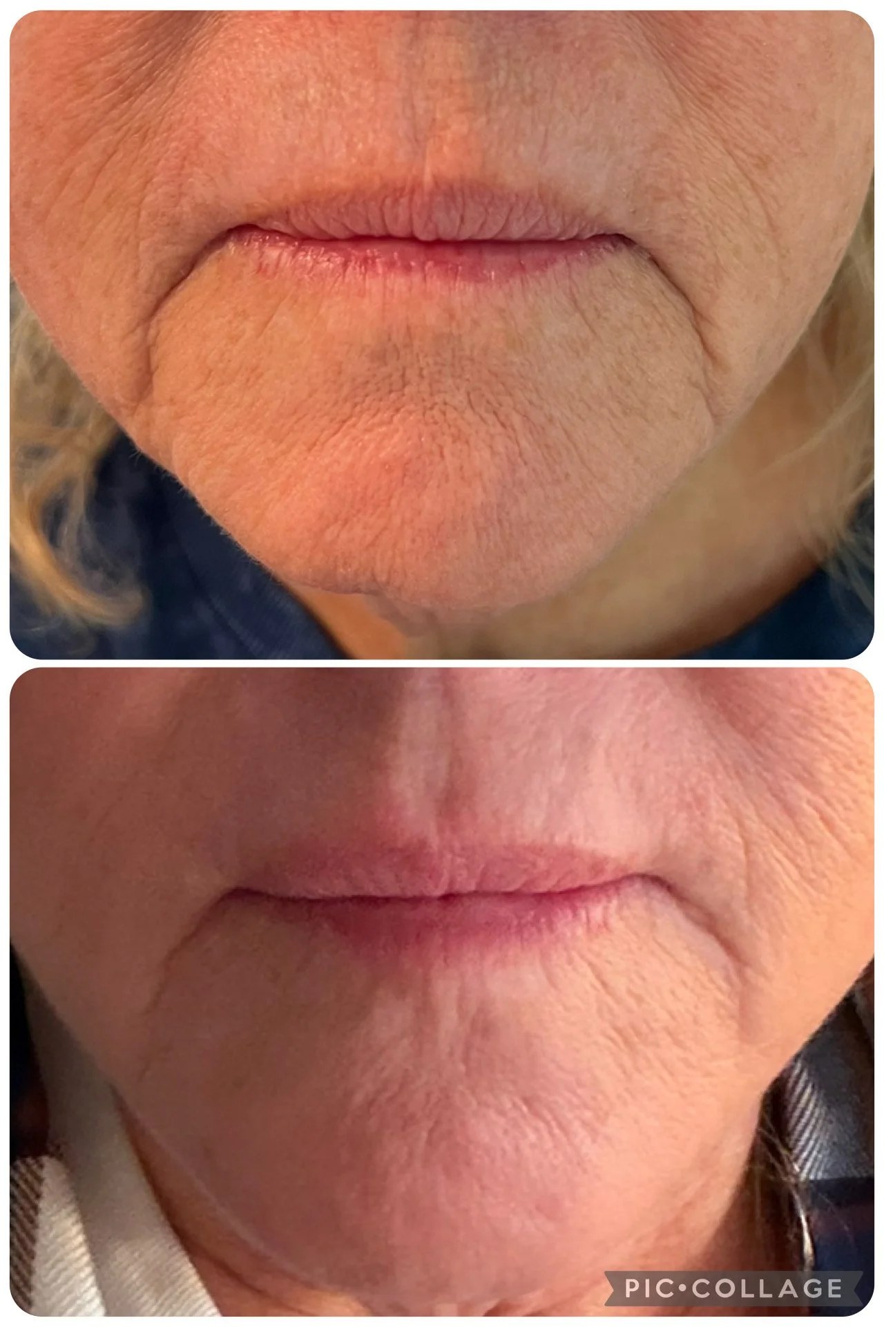 Close-up of a person's mouth and chin, with the top image showing facial wrinkles and the bottom image showing smoother skin.