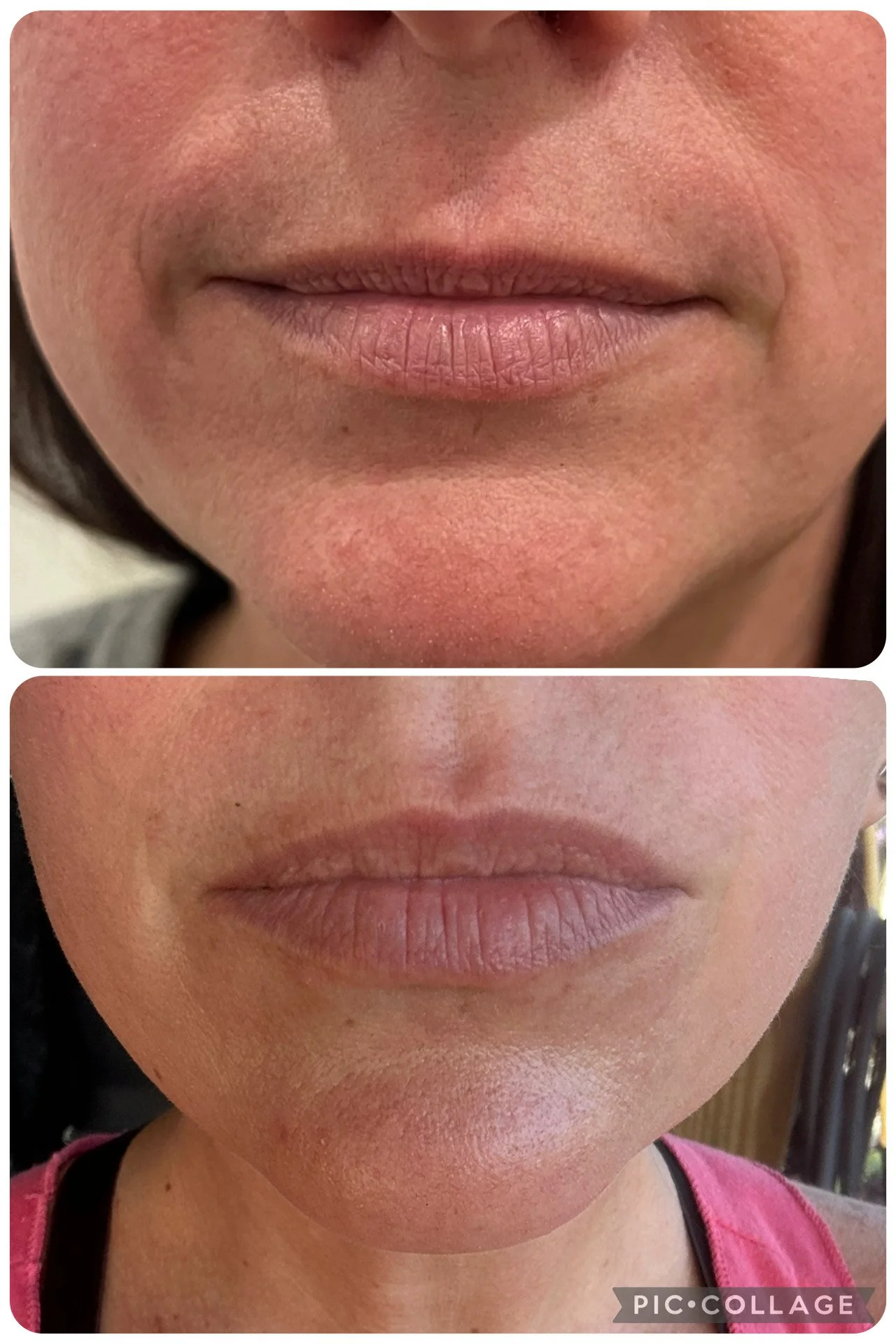 Close-up of a person's lips and lower face showing before and after lip enhancement or cosmetic procedure, with smoother and fuller lips in the after image.