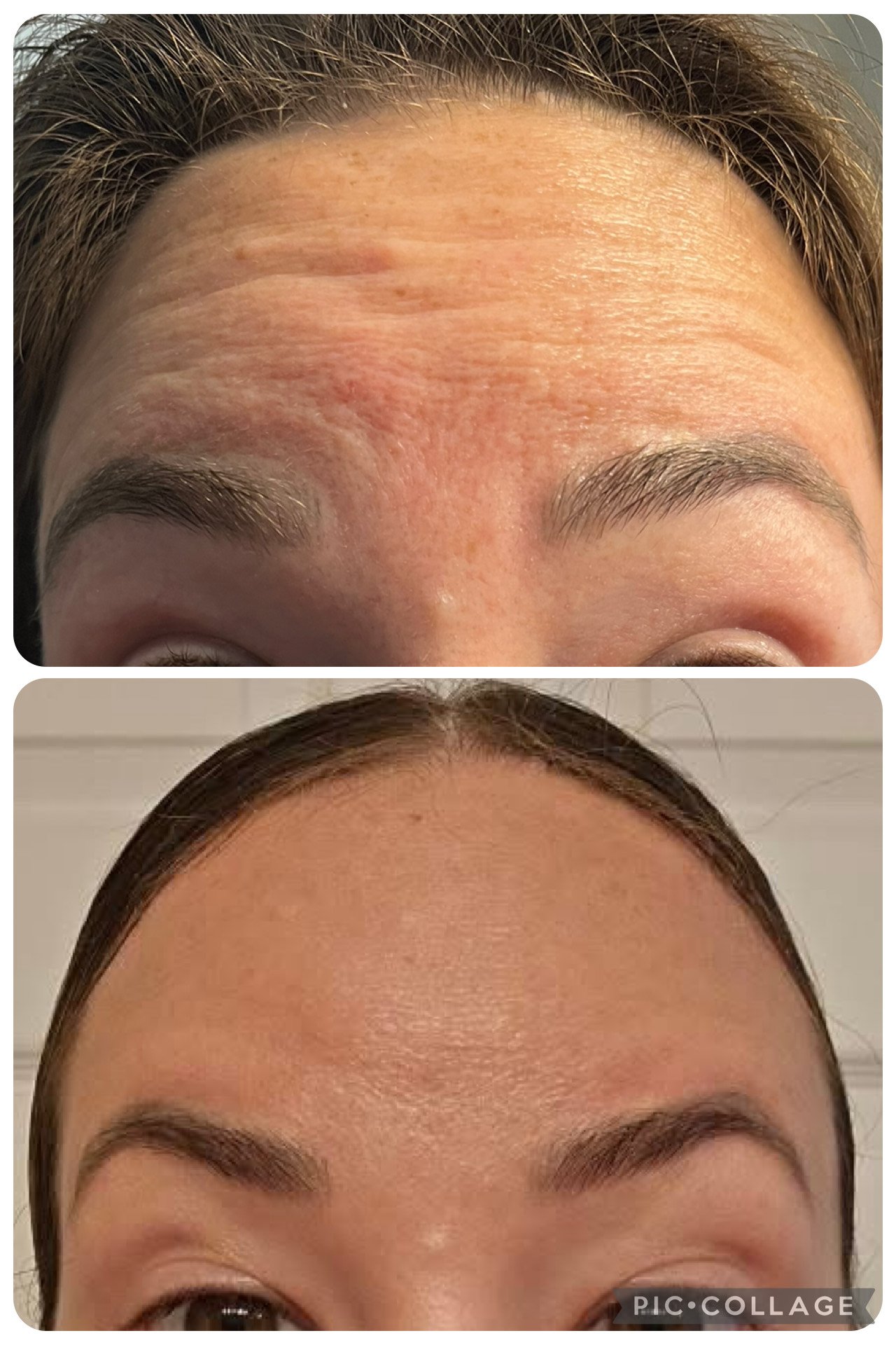 Comparison of a person's forehead before and after skincare treatment, showing reduced redness and improved skin texture.
