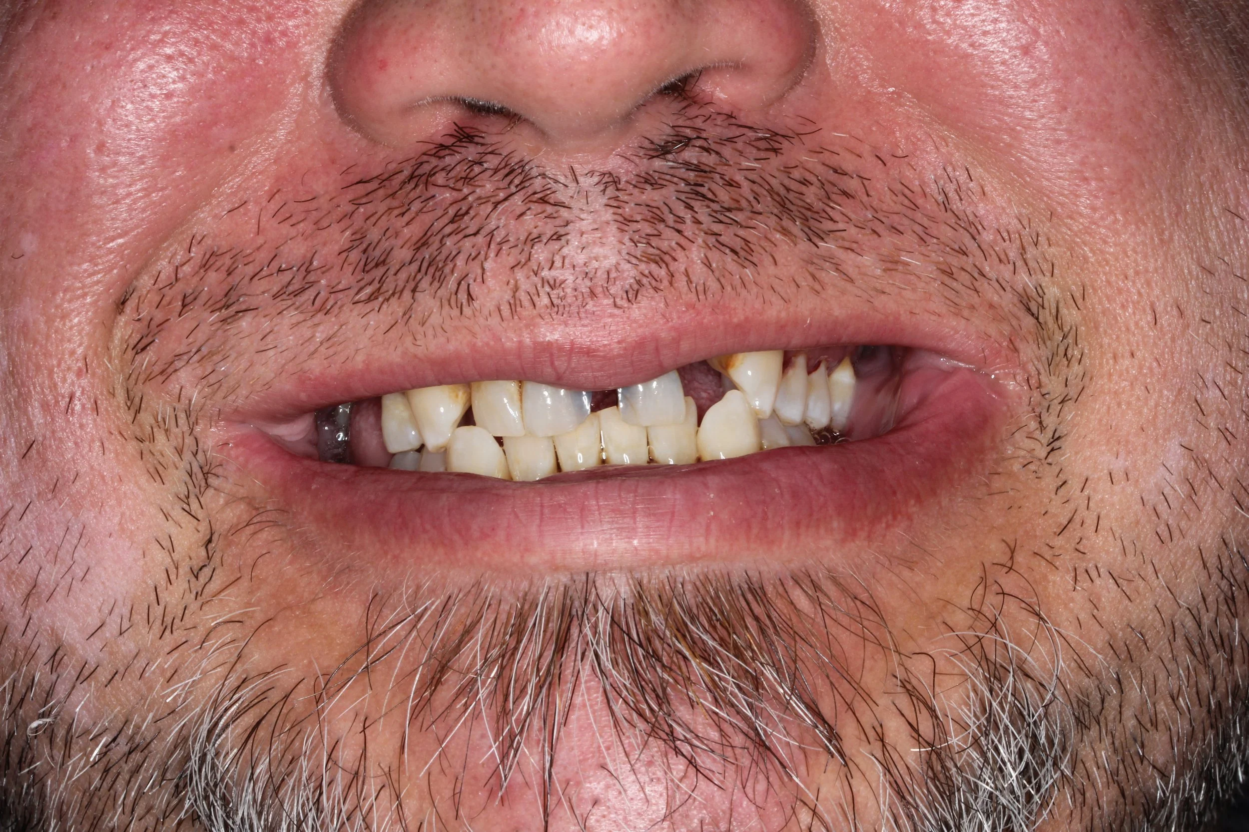 Photo of teeth that are discolored - black and yellow with spaces