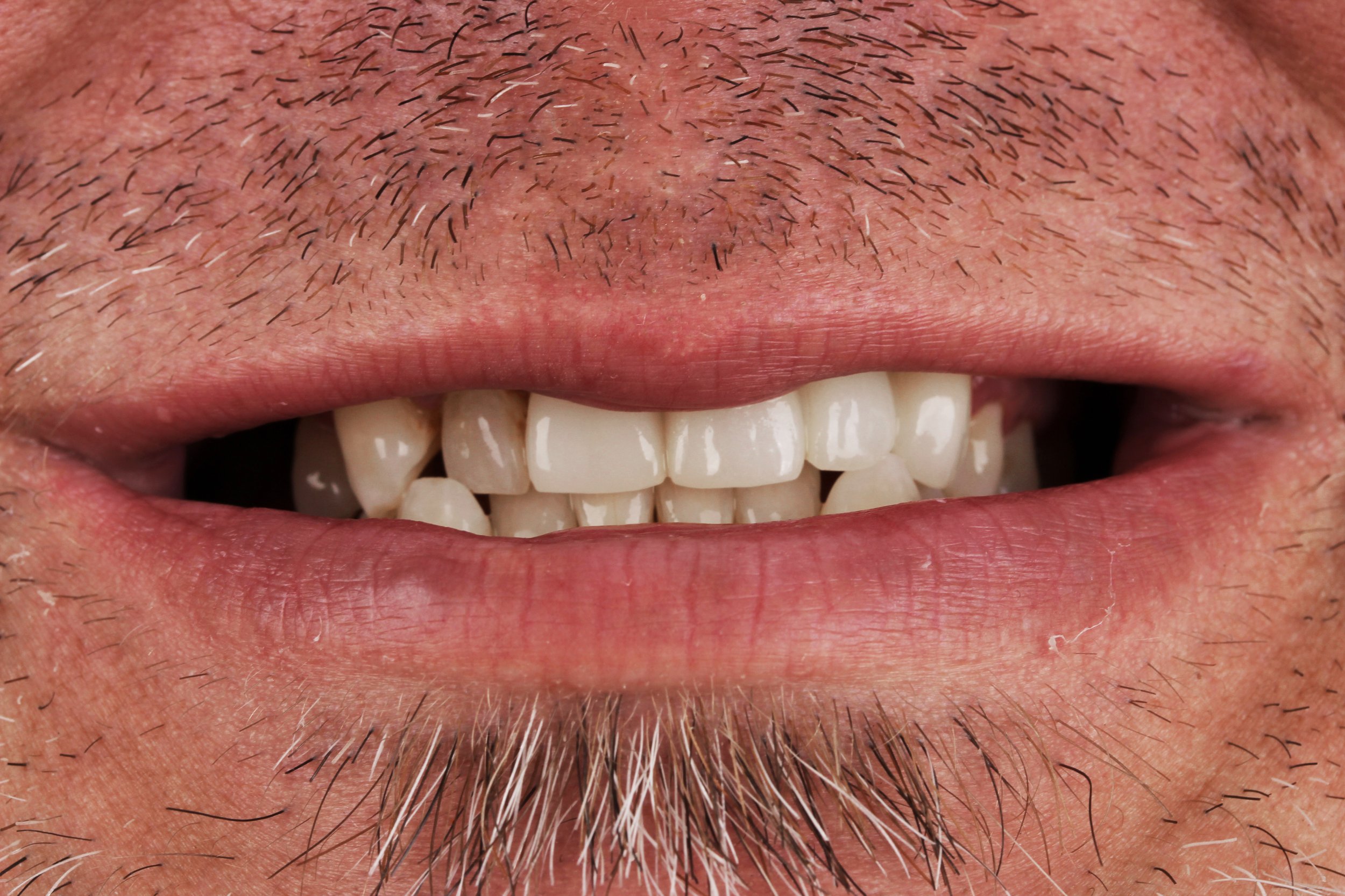 photo of teeth repaired with cosmetic attractive crowns