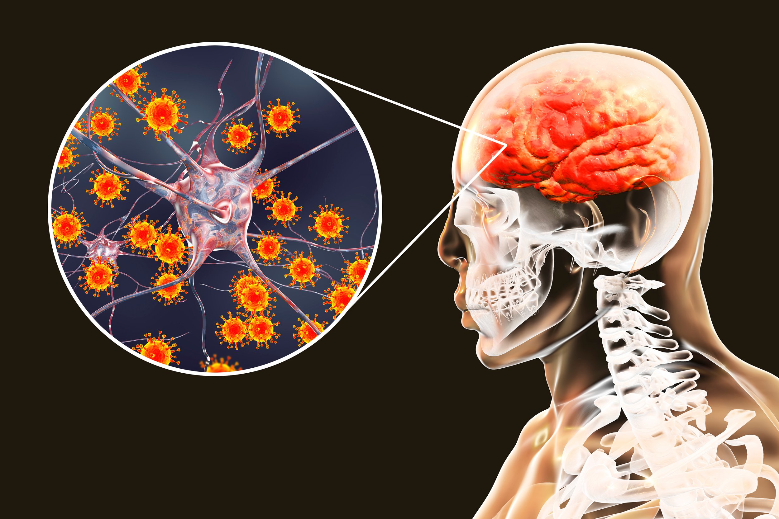 The Role of EBV and CMV in Autism