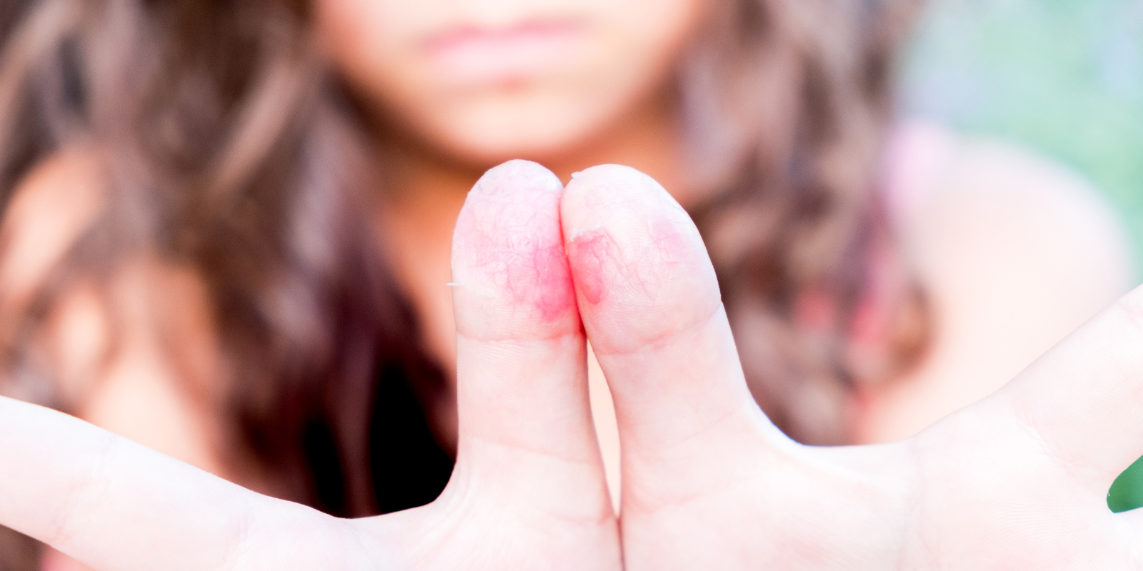 Cracking the Code: Skin Issues in Autism – Unmasking Triggers