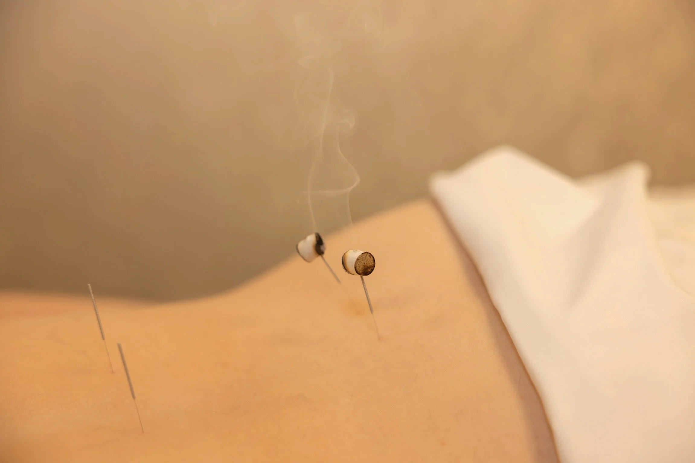 The Acupuncture - A Okay Wellness