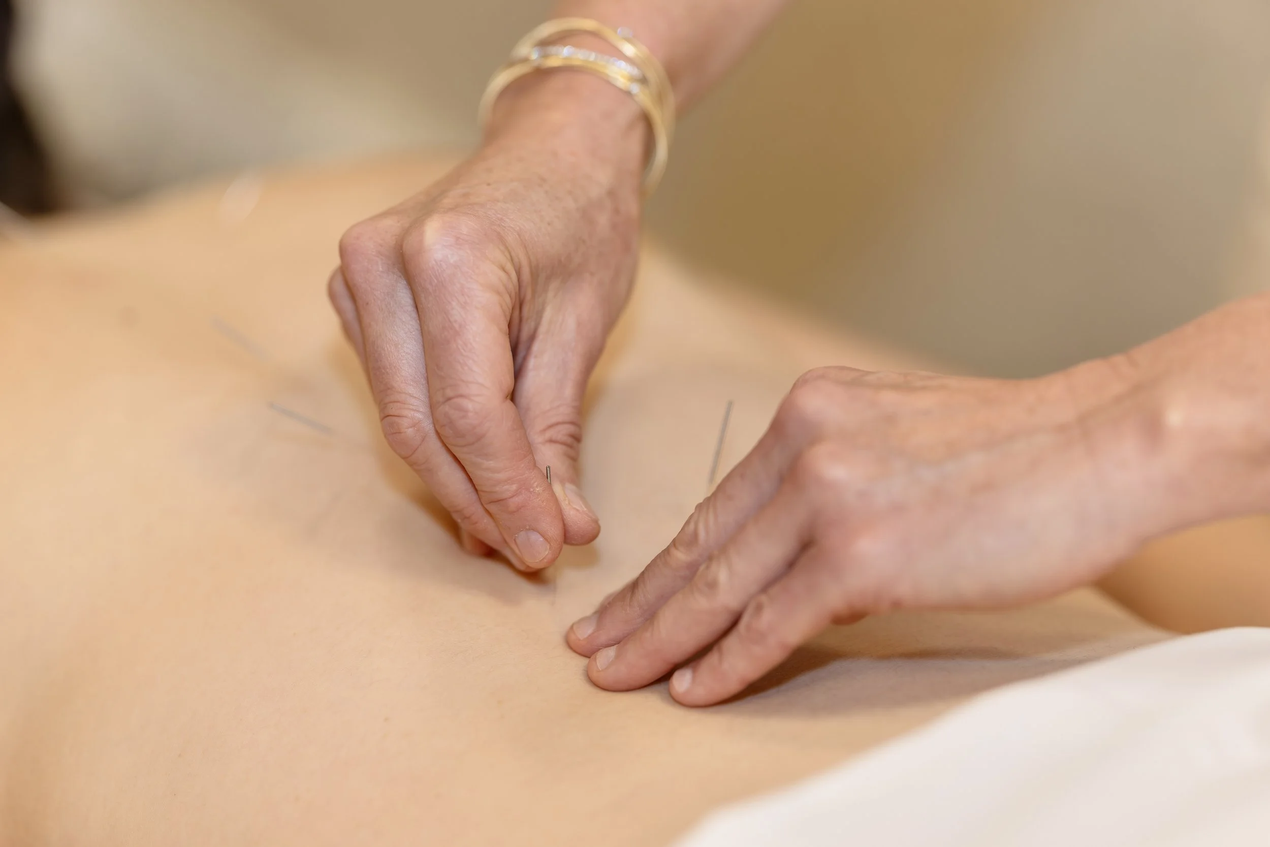 The Acupuncture - A Okay Wellness