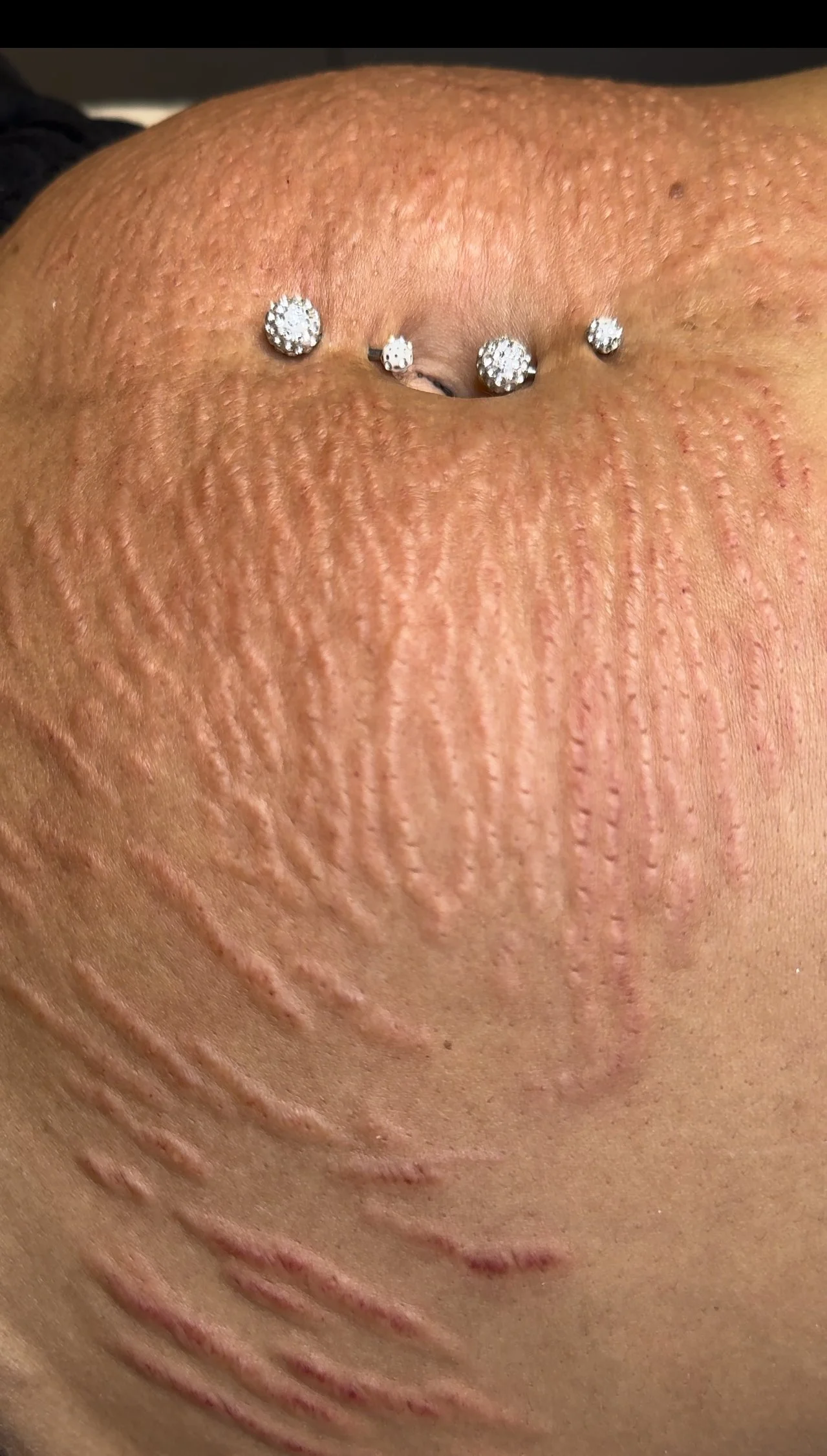 Does Stretch Mark Camouflaging Really Work?