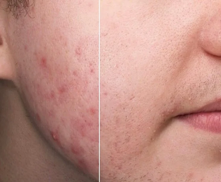 Rosacea improvement