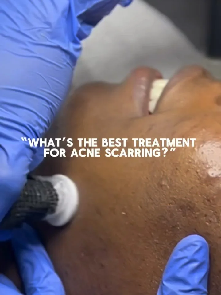 What&rsquo;s the best treatment for acne scarring?
✨Procell Microchanneling.✨
Smooths texture, fades scars, boosts your glow, with minimal downtime. 

📌Minimum for acne scarring: ~4&ndash;6 sessions spaced about 3&ndash;4 weeks apart. 

#denverproce
